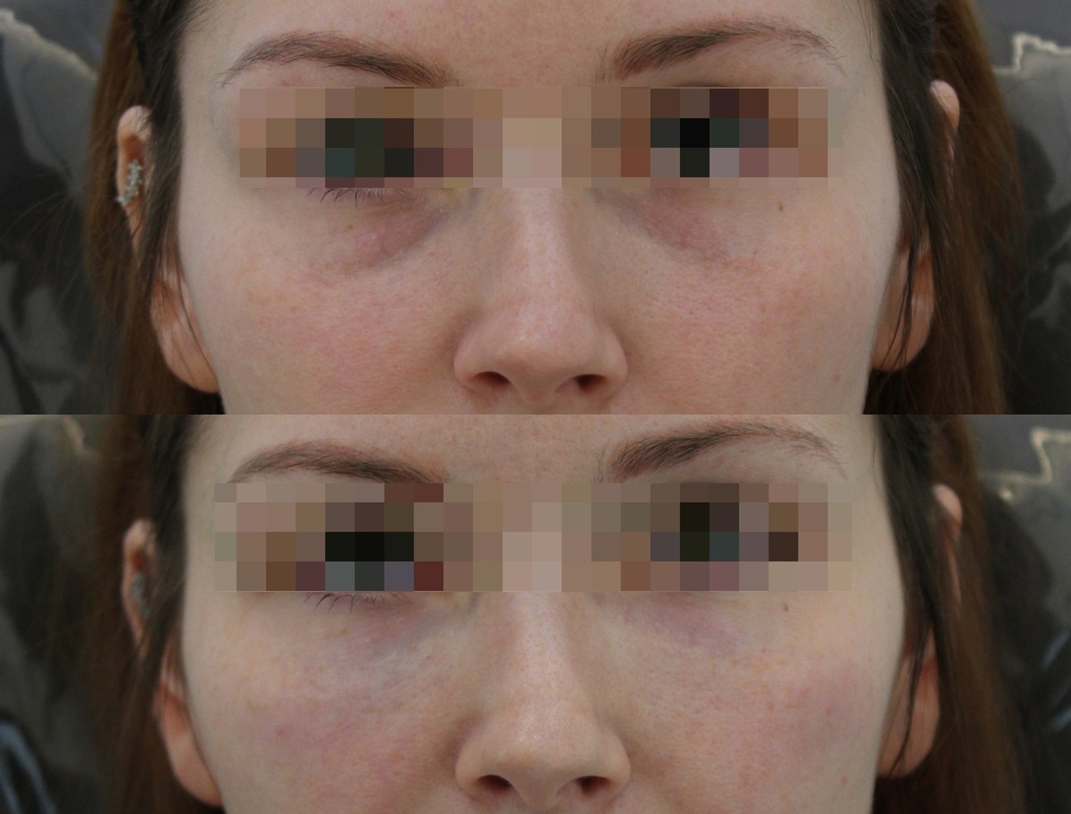 Under-eye comparison — stacked close-ups at PLANEW Clinic. Under-eye comparison — stacked close-ups at PLANEW Clinic: Stacked close-ups show the upper cheeks and the area beneath the eyes. The source eye coverings are retained; the treatment and follow-up stage are not specified.