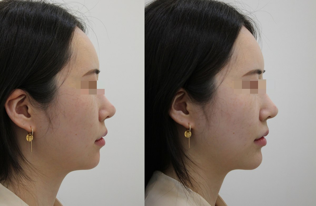 Facial comparison — right profile at PLANEW Clinic. Facial comparison — right profile at PLANEW Clinic: Side-by-side views facing right show the profile, cheek and chin. Head tilt and camera position differ slightly.