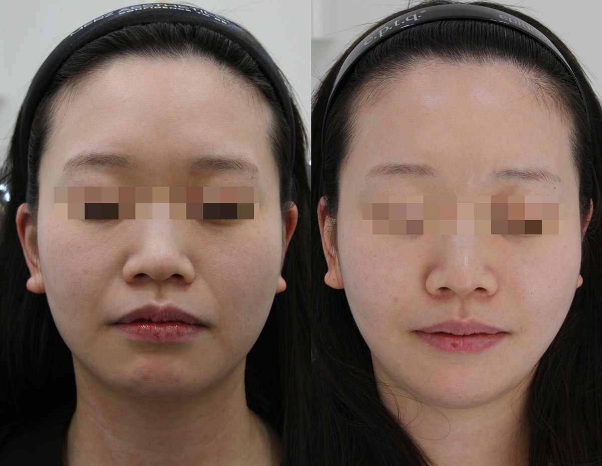 Facial comparison — frontal view 05 at PLANEW Clinic. Facial comparison — frontal view 05 at PLANEW Clinic: Frontal views show the cheeks, mouth corners and jawline. The mouth position and facial expression differ between photographs.