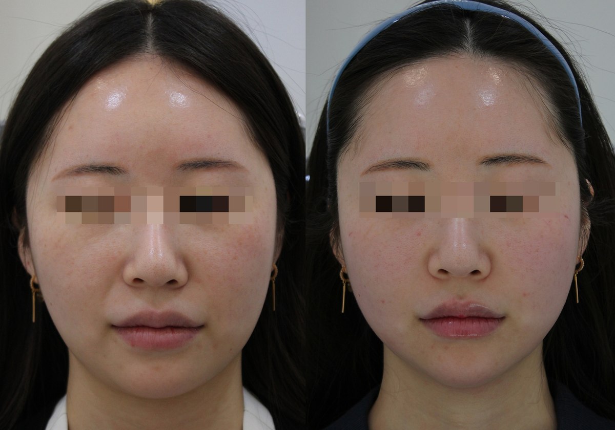Facial comparison — frontal view 06 at PLANEW Clinic. Facial comparison — frontal view 06 at PLANEW Clinic: Two frontal views show the cheeks, nose-to-mouth folds and lower-face outline. The hair framing and skin tone under the lighting differ.