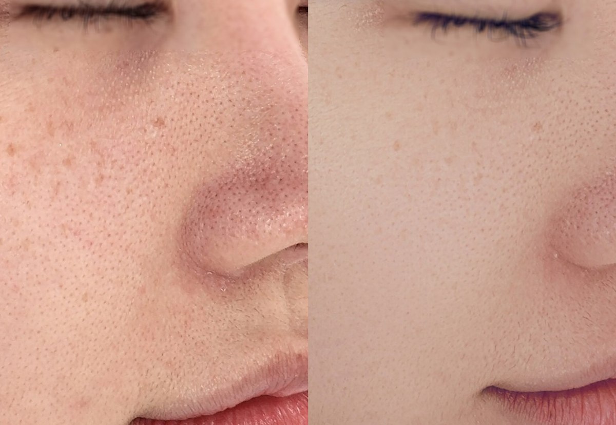 Cheek skin texture — close-up comparison at PLANEW Clinic. Cheek skin texture — close-up comparison at PLANEW Clinic: Close-up photographs show the cheek beside the nose, including visible pores and surface texture. Differences in illumination and image processing can affect the appearance of skin texture.