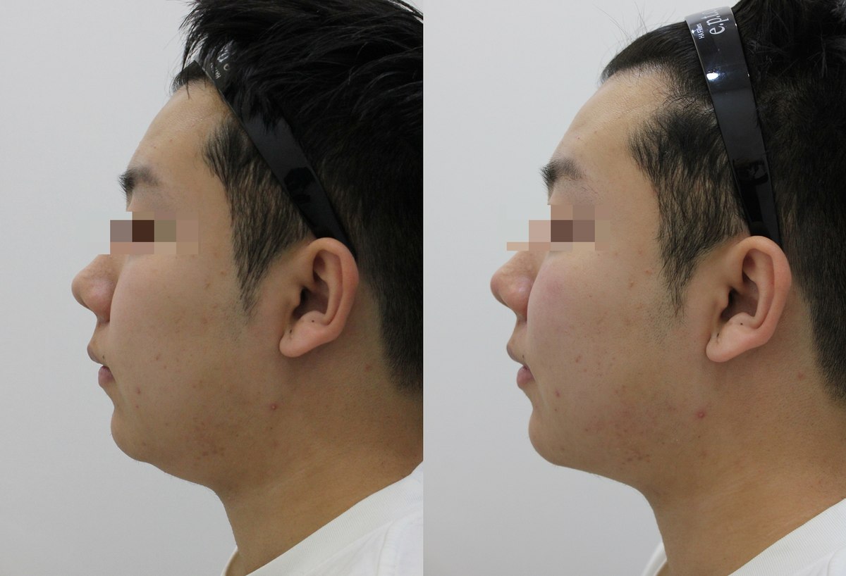 Facial comparison — left profile at PLANEW Clinic. Facial comparison — left profile at PLANEW Clinic: Two profile views facing left show the cheek, chin and lower-face outline. Compare these contours allowing for differences in posture and framing.