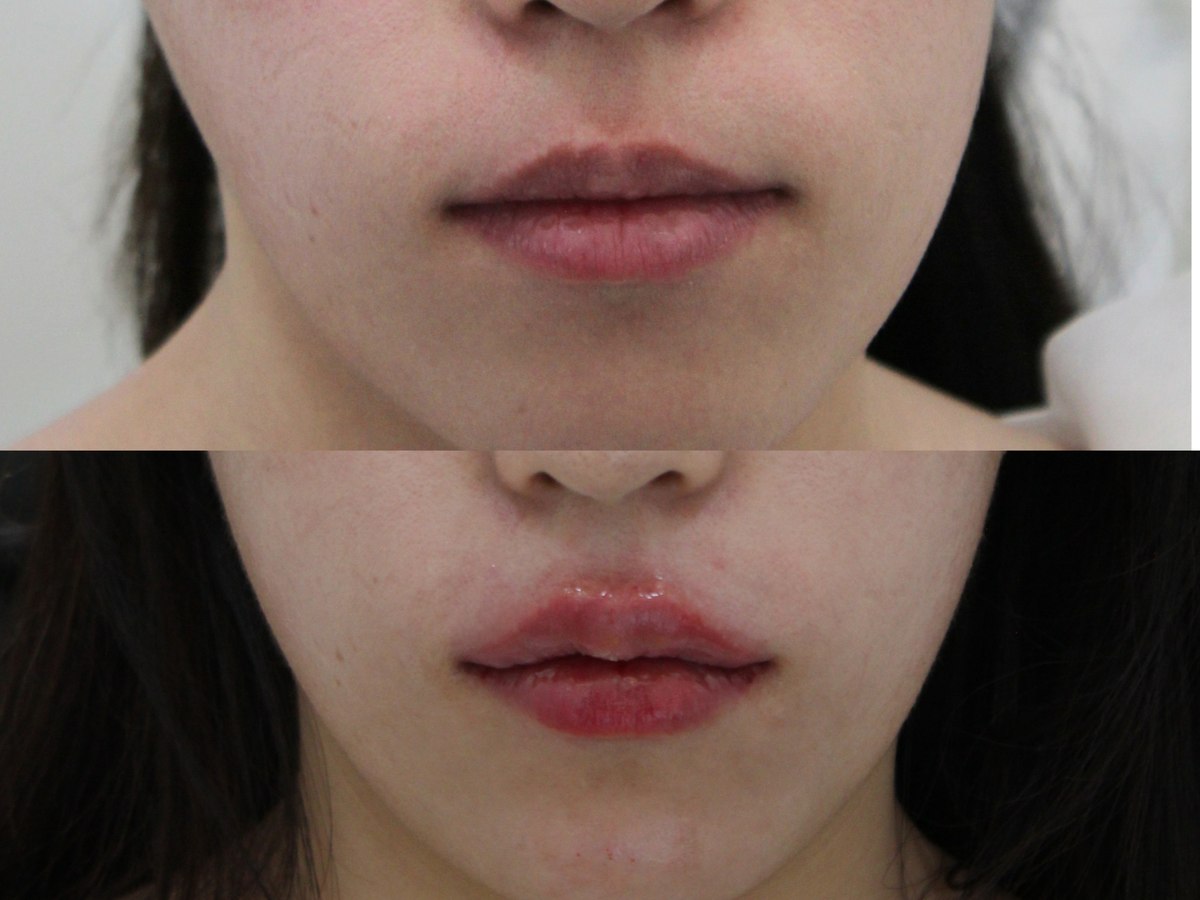Lip comparison — close-up 02 at PLANEW Clinic. Lip comparison — close-up 02 at PLANEW Clinic: Stacked close-ups show the lip borders, upper-lip curve and central lower lip. The lip position and framing differ between the two images.