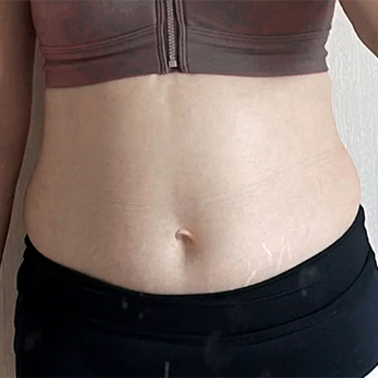 Abdominal contour — front comparison 01 at PLANS Clinic Myeongdong. PLANS Clinic Myeongdong, Seoul: Abdominal contour — front comparison 01. Before photograph, identified by the clinic filename.