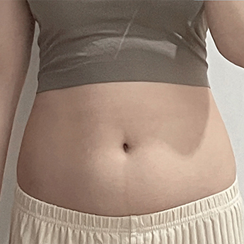 Abdominal contour — front comparison 02 at PLANS Clinic Myeongdong. PLANS Clinic Myeongdong, Seoul: Abdominal contour — front comparison 02. Before photograph, identified by the clinic filename.