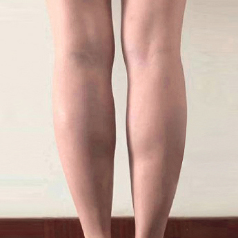 Calf contour — lower-leg comparison at PLANS Clinic Myeongdong. PLANS Clinic Myeongdong, Seoul: Calf contour — lower-leg comparison. Before photograph, identified by the clinic filename.