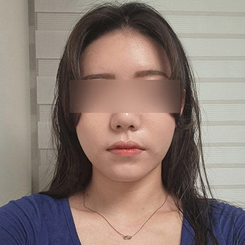 Facial contour — front view at PLANS Clinic Myeongdong. PLANS Clinic Myeongdong, Seoul: Facial contour — front view. Before photograph, identified by the clinic filename.
