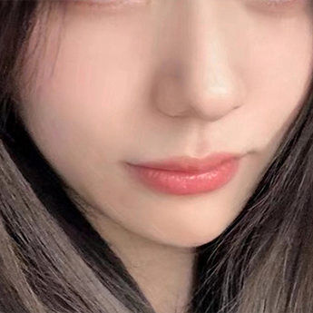 Jawline — lower-face comparison at PLANS Clinic Myeongdong. PLANS Clinic Myeongdong, Seoul: Jawline — lower-face comparison. After photograph, identified by the clinic filename.