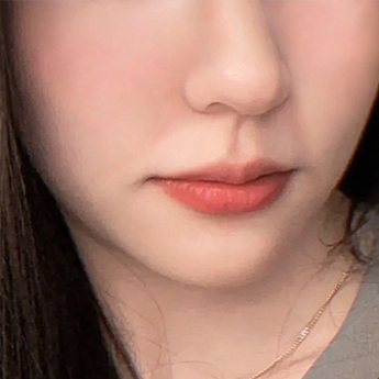 Jawline — lower-face comparison at PLANS Clinic Myeongdong. PLANS Clinic Myeongdong, Seoul: Jawline — lower-face comparison. Before photograph, identified by the clinic filename.