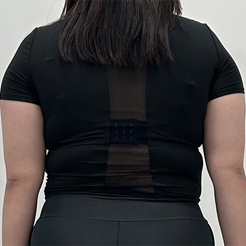 Upper-body contour — back view at PLANS Clinic Myeongdong. PLANS Clinic Myeongdong, Seoul: Upper-body contour — back view. Before photograph, identified by the clinic filename.