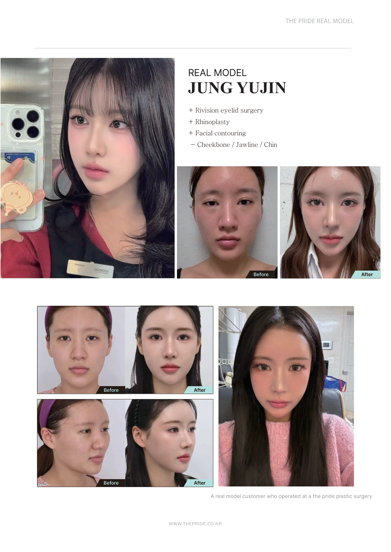 Revision eyelid surgery, rhinoplasty and facial contouring at The Pride Plastic Surgery. The Pride Plastic Surgery, Seoul: revision eyelid surgery, rhinoplasty and facial contouring, reproduced from page 3 of the clinic-supplied booklet. Before-and-after labels and photographed views remain as supplied.