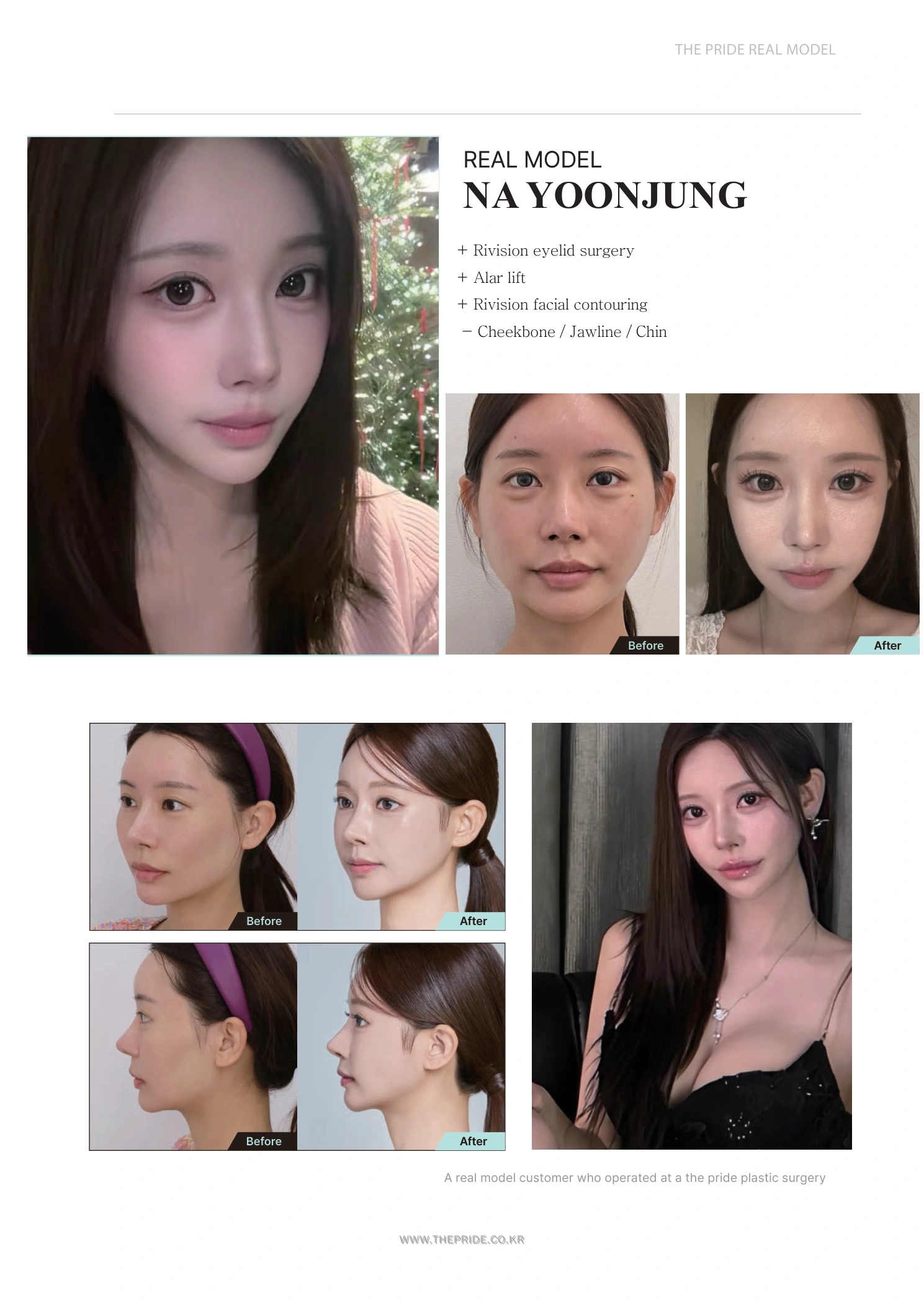 Revision eyelid surgery, alar lift and revision facial contouring at The Pride Plastic Surgery. The Pride Plastic Surgery, Seoul: revision eyelid surgery, alar lift and revision facial contouring, reproduced from page 5 of the clinic-supplied booklet. Before-and-after labels and photographed views remain as supplied.