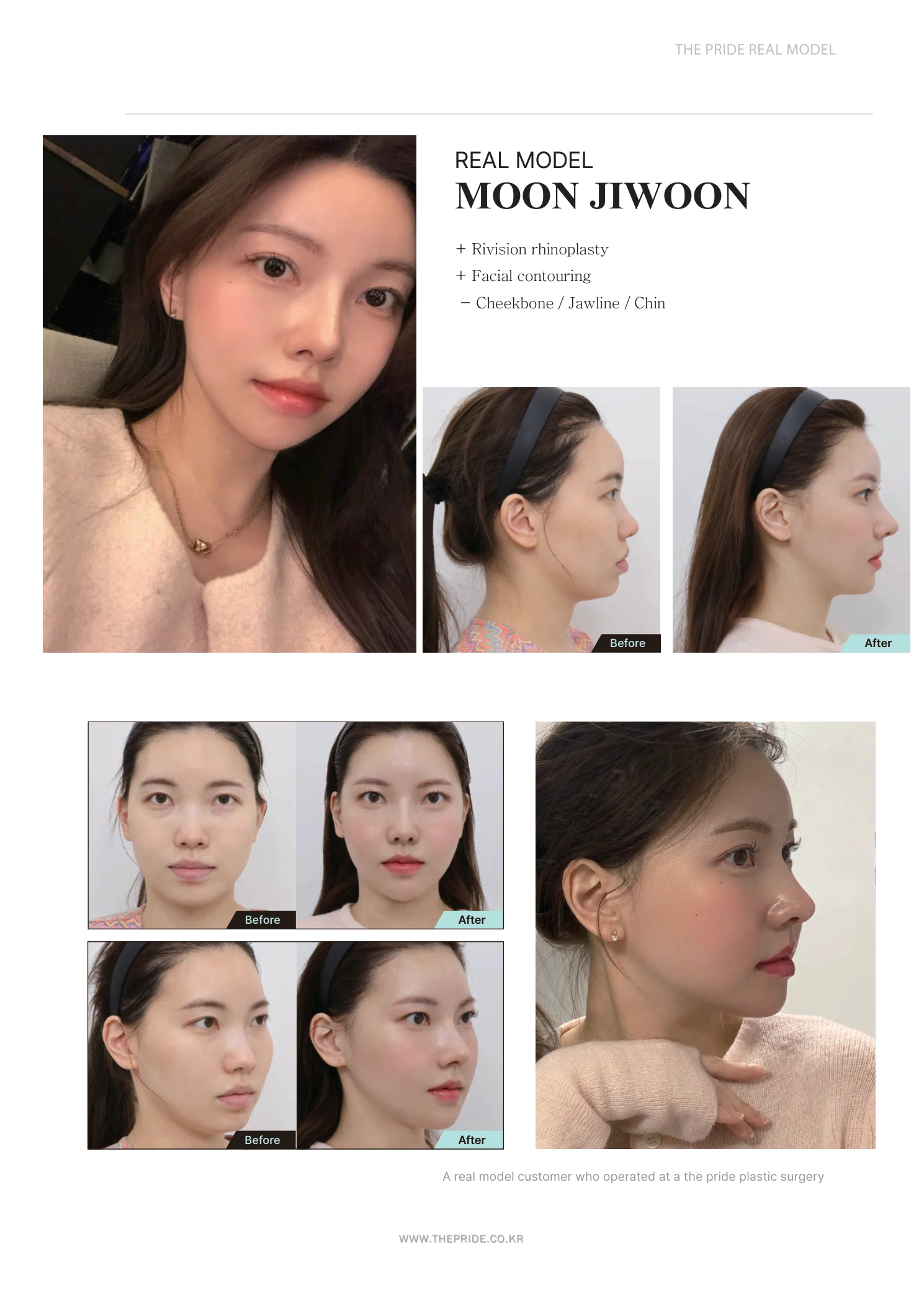 Revision rhinoplasty and facial contouring at The Pride Plastic Surgery. The Pride Plastic Surgery, Seoul: revision rhinoplasty and facial contouring, reproduced from page 7 of the clinic-supplied booklet. Before-and-after labels and photographed views remain as supplied.