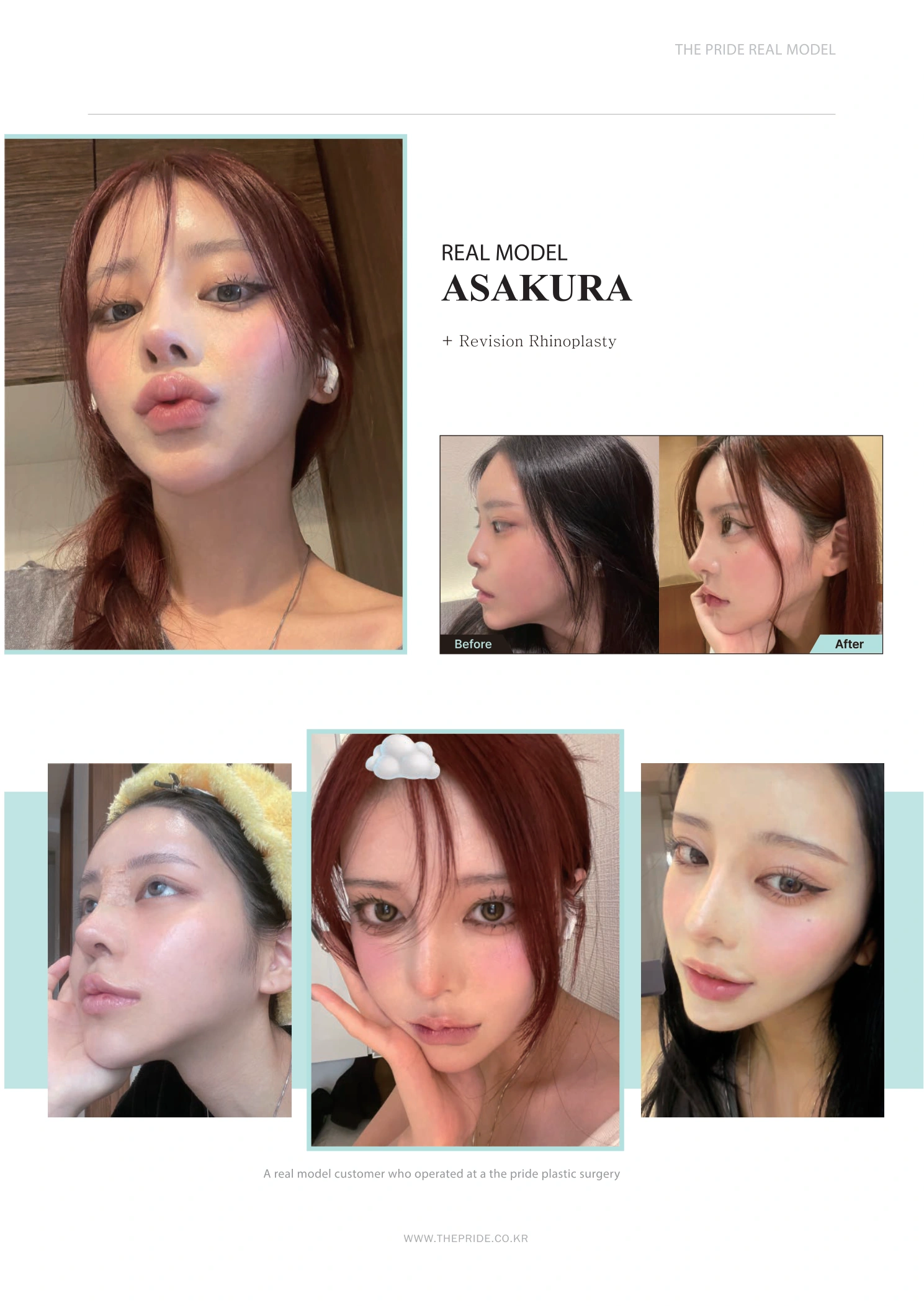 Revision rhinoplasty — model photo story at The Pride Plastic Surgery. The Pride Plastic Surgery, Seoul: revision rhinoplasty — model photo story, reproduced from page 11 of the clinic-supplied booklet. Before-and-after labels and photographed views remain as supplied.