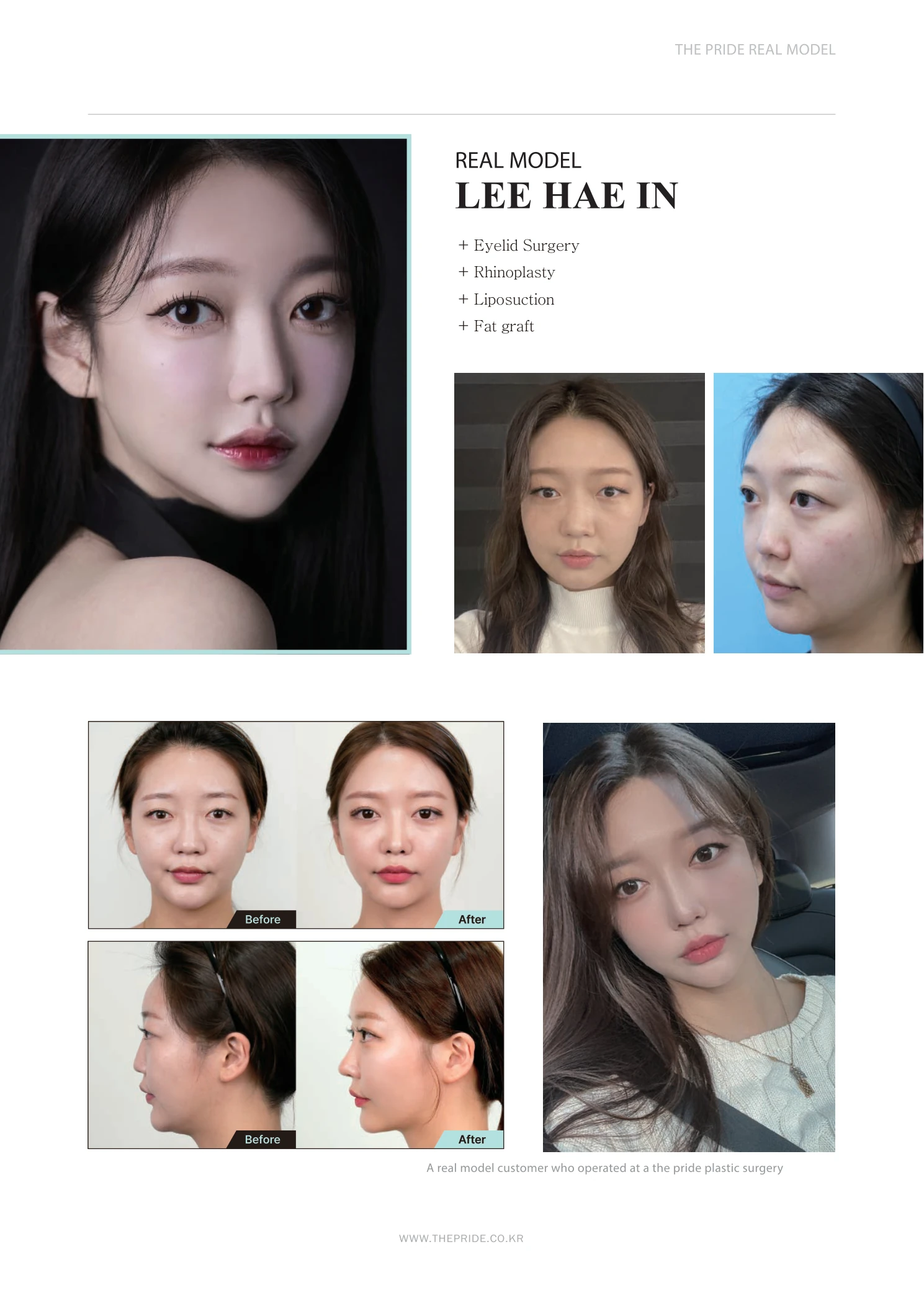 Eyelid surgery, rhinoplasty, liposuction and fat grafting at The Pride Plastic Surgery. The Pride Plastic Surgery, Seoul: eyelid surgery, rhinoplasty, liposuction and fat grafting, reproduced from page 13 of the clinic-supplied booklet. Before-and-after labels and photographed views remain as supplied.