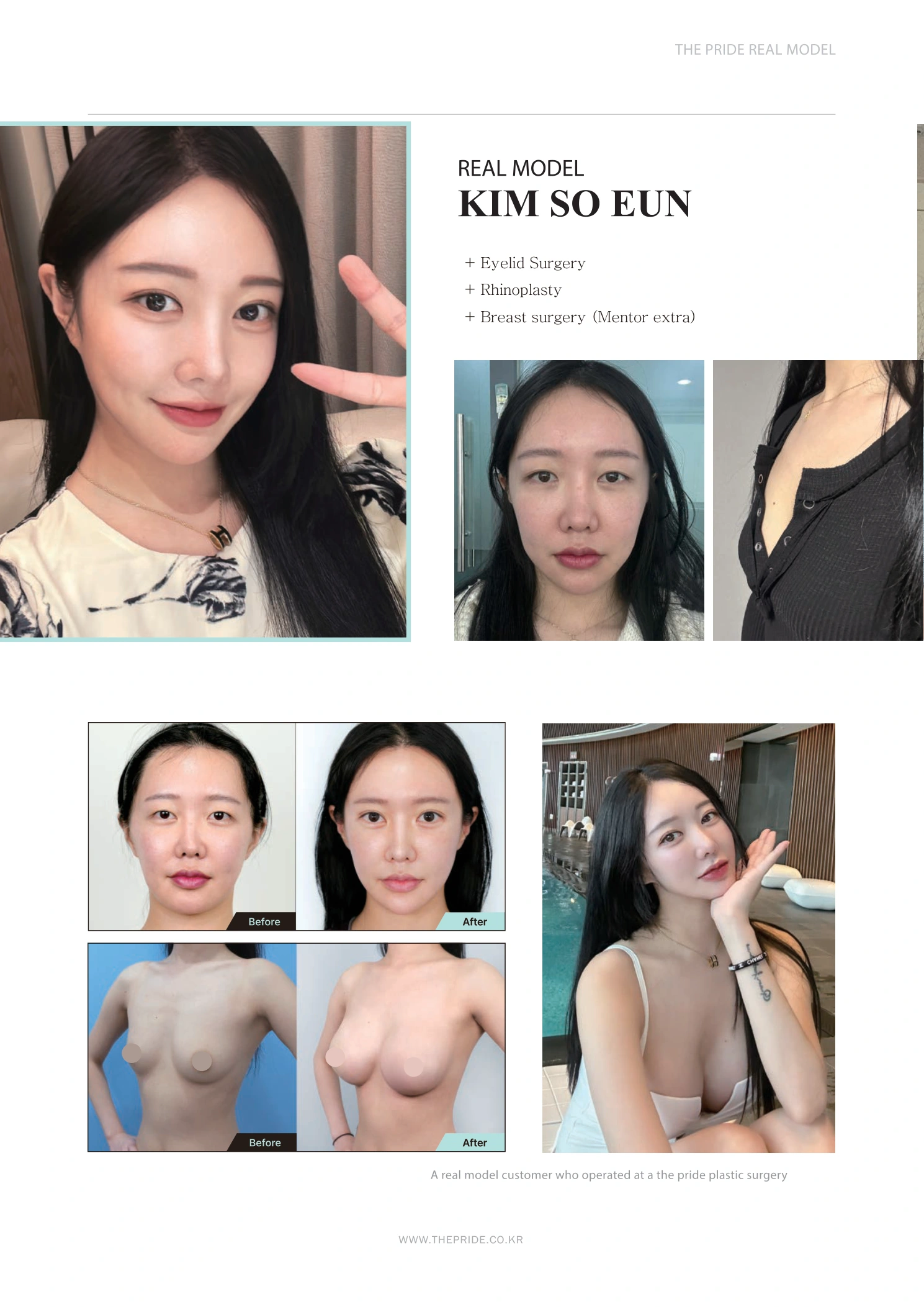 Eyelid surgery, rhinoplasty and breast surgery — collection 01 at The Pride Plastic Surgery. The Pride Plastic Surgery, Seoul: eyelid surgery, rhinoplasty and breast surgery — collection 01, reproduced from page 15 of the clinic-supplied booklet. Before-and-after labels and photographed views remain as supplied.