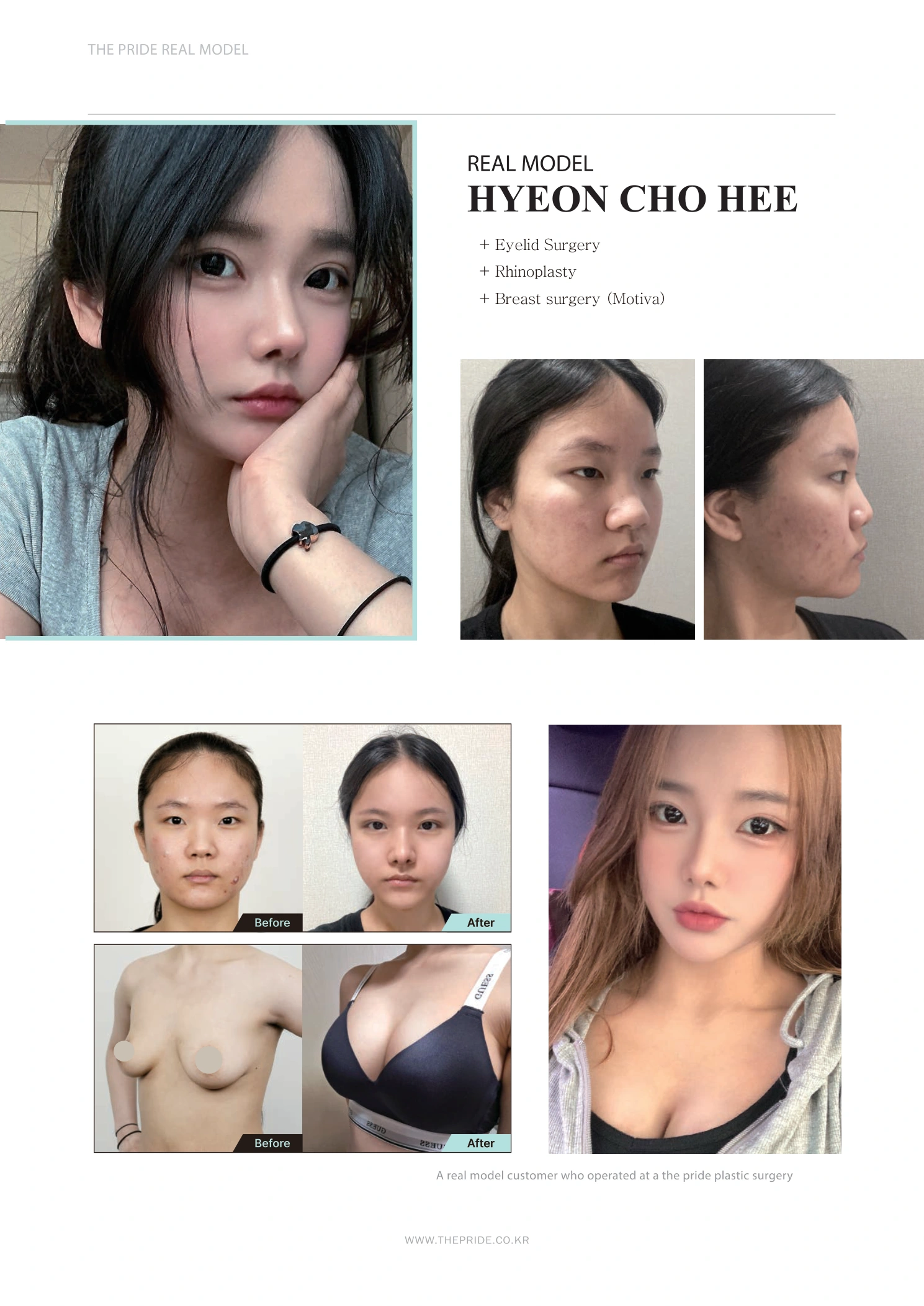 Eyelid surgery, rhinoplasty and breast surgery — collection 02 at The Pride Plastic Surgery. The Pride Plastic Surgery, Seoul: eyelid surgery, rhinoplasty and breast surgery — collection 02, reproduced from page 16 of the clinic-supplied booklet. Before-and-after labels and photographed views remain as supplied.