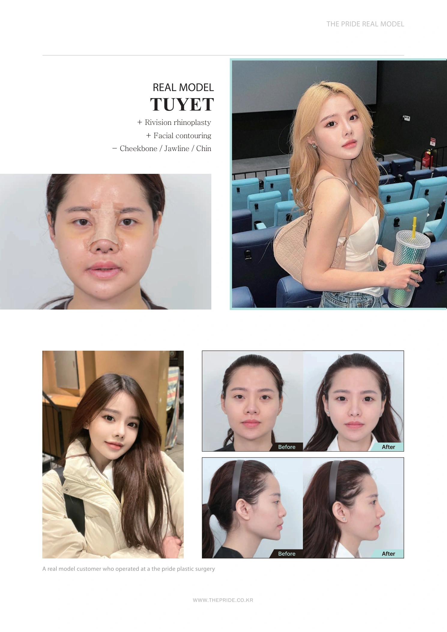 Revision rhinoplasty with cheekbone, jawline and chin contouring at The Pride Plastic Surgery. The Pride Plastic Surgery, Seoul: revision rhinoplasty with cheekbone, jawline and chin contouring, reproduced from page 17 of the clinic-supplied booklet. Before-and-after labels and photographed views remain as supplied.