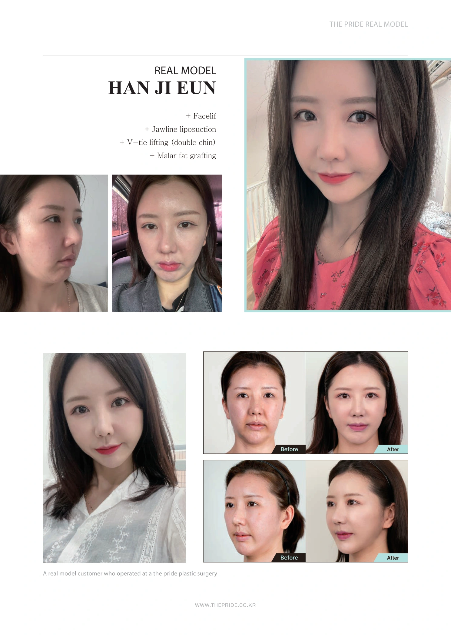 Facelift, jawline liposuction, double-chin lifting and fat grafting at The Pride Plastic Surgery. The Pride Plastic Surgery, Seoul: facelift, jawline liposuction, double-chin lifting and fat grafting, reproduced from page 19 of the clinic-supplied booklet. Before-and-after labels and photographed views remain as…