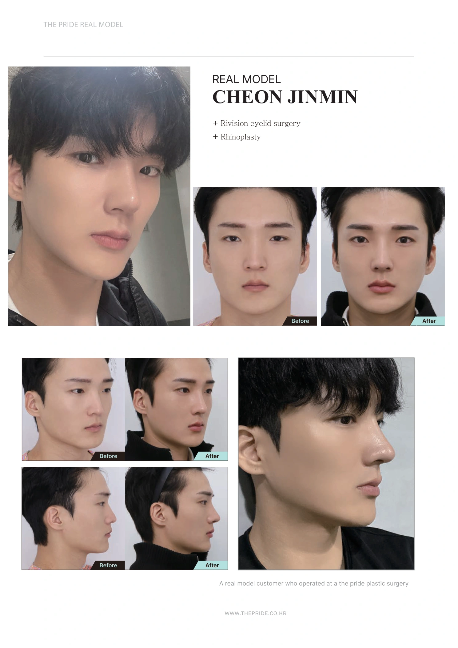 Revision eyelid surgery and rhinoplasty at The Pride Plastic Surgery. The Pride Plastic Surgery, Seoul: revision eyelid surgery and rhinoplasty, reproduced from page 20 of the clinic-supplied booklet. Before-and-after labels and photographed views remain as supplied.