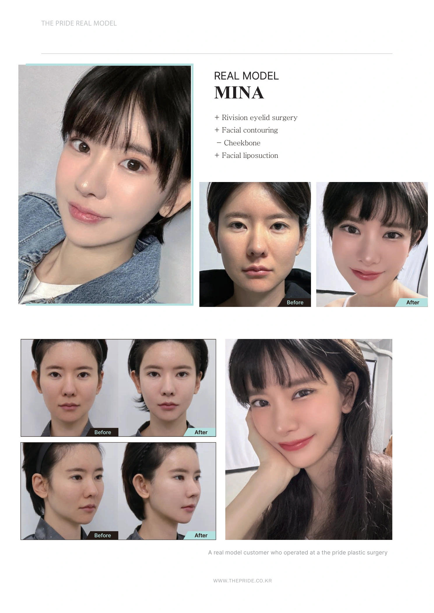 Revision eyelid surgery, cheekbone contouring and facial liposuction at The Pride Plastic Surgery. The Pride Plastic Surgery, Seoul: revision eyelid surgery, cheekbone contouring and facial liposuction, reproduced from page 22 of the clinic-supplied booklet. Before-and-after labels and photographed views remain as…