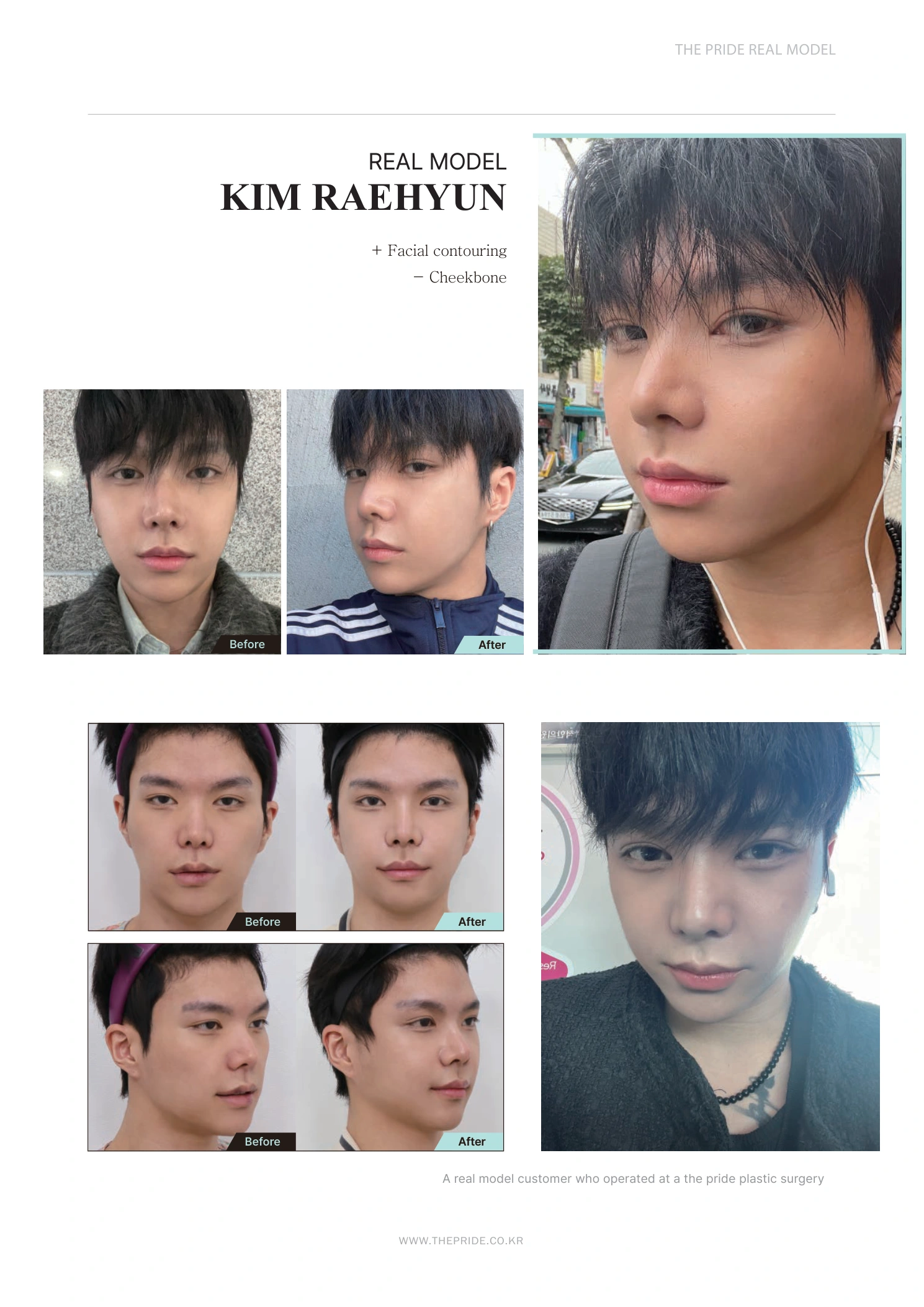 Cheekbone contouring — photo story at The Pride Plastic Surgery. The Pride Plastic Surgery, Seoul: cheekbone contouring — photo story, reproduced from page 23 of the clinic-supplied booklet. Before-and-after labels and photographed views remain as supplied.