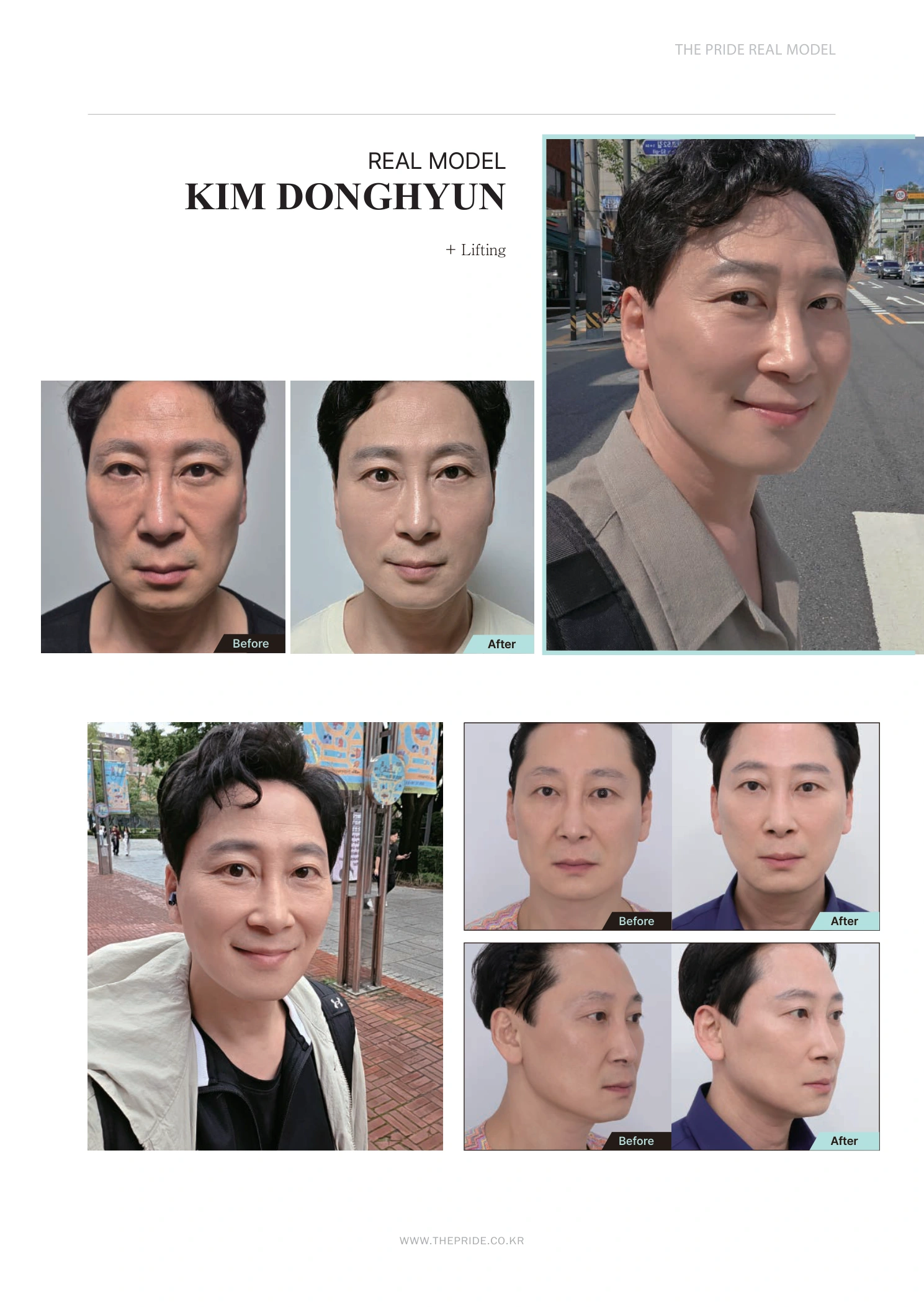 Facial lifting — photo story at The Pride Plastic Surgery. The Pride Plastic Surgery, Seoul: facial lifting — photo story, reproduced from page 25 of the clinic-supplied booklet. Before-and-after labels and photographed views remain as supplied.