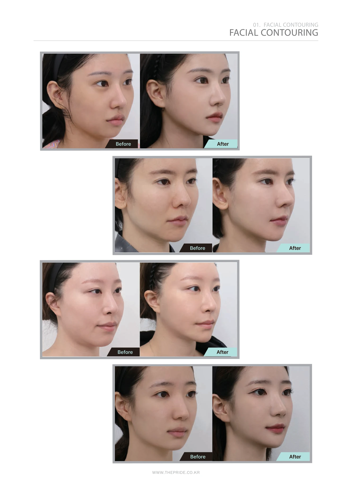 Facial contouring — collection 01 at The Pride Plastic Surgery. The Pride Plastic Surgery, Seoul: facial contouring — collection 01, reproduced from page 27 of the clinic-supplied booklet. Before-and-after labels and photographed views remain as supplied.