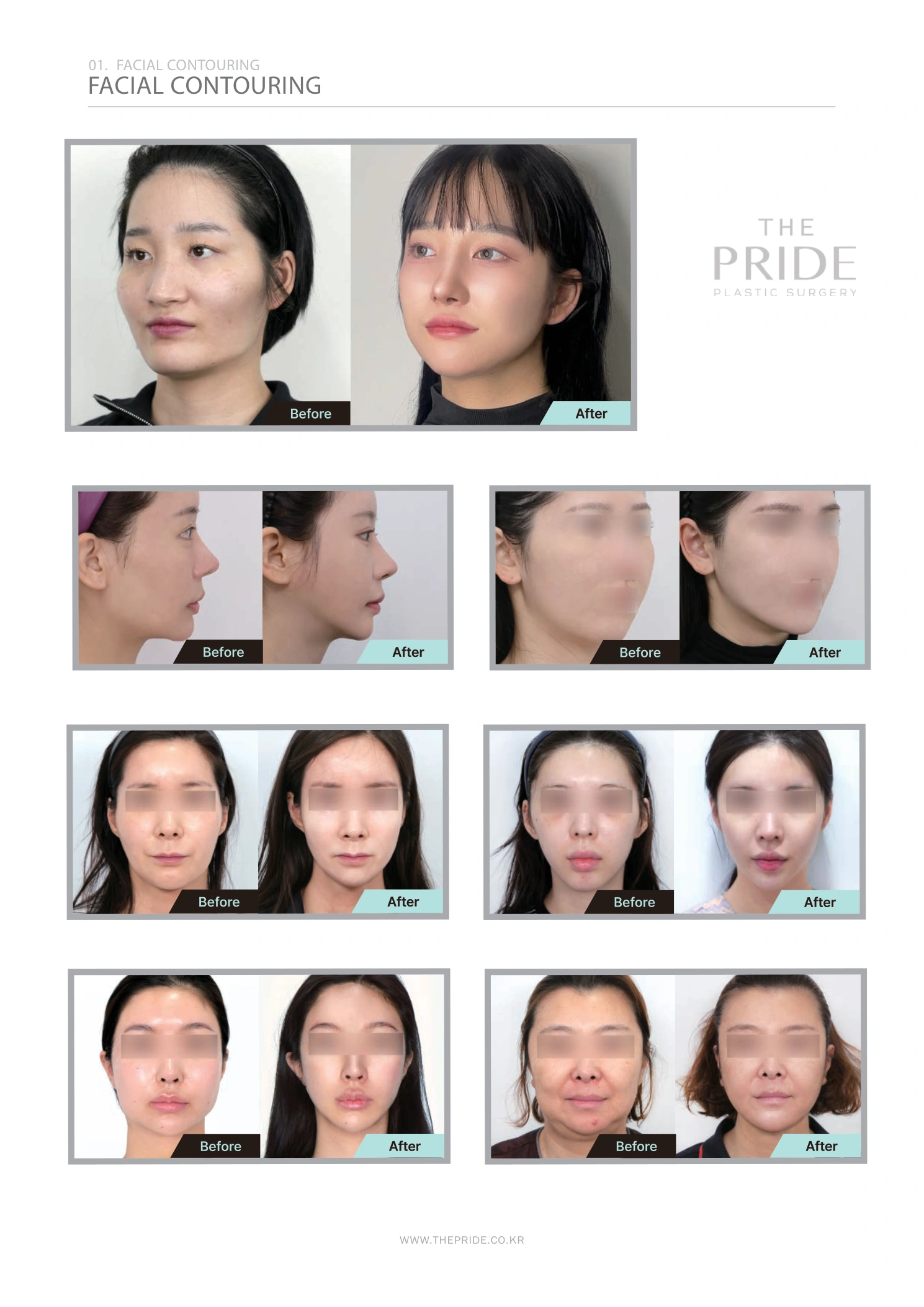 Facial contouring — collection 02 at The Pride Plastic Surgery. The Pride Plastic Surgery, Seoul: facial contouring — collection 02, reproduced from page 28 of the clinic-supplied booklet. Before-and-after labels and photographed views remain as supplied.