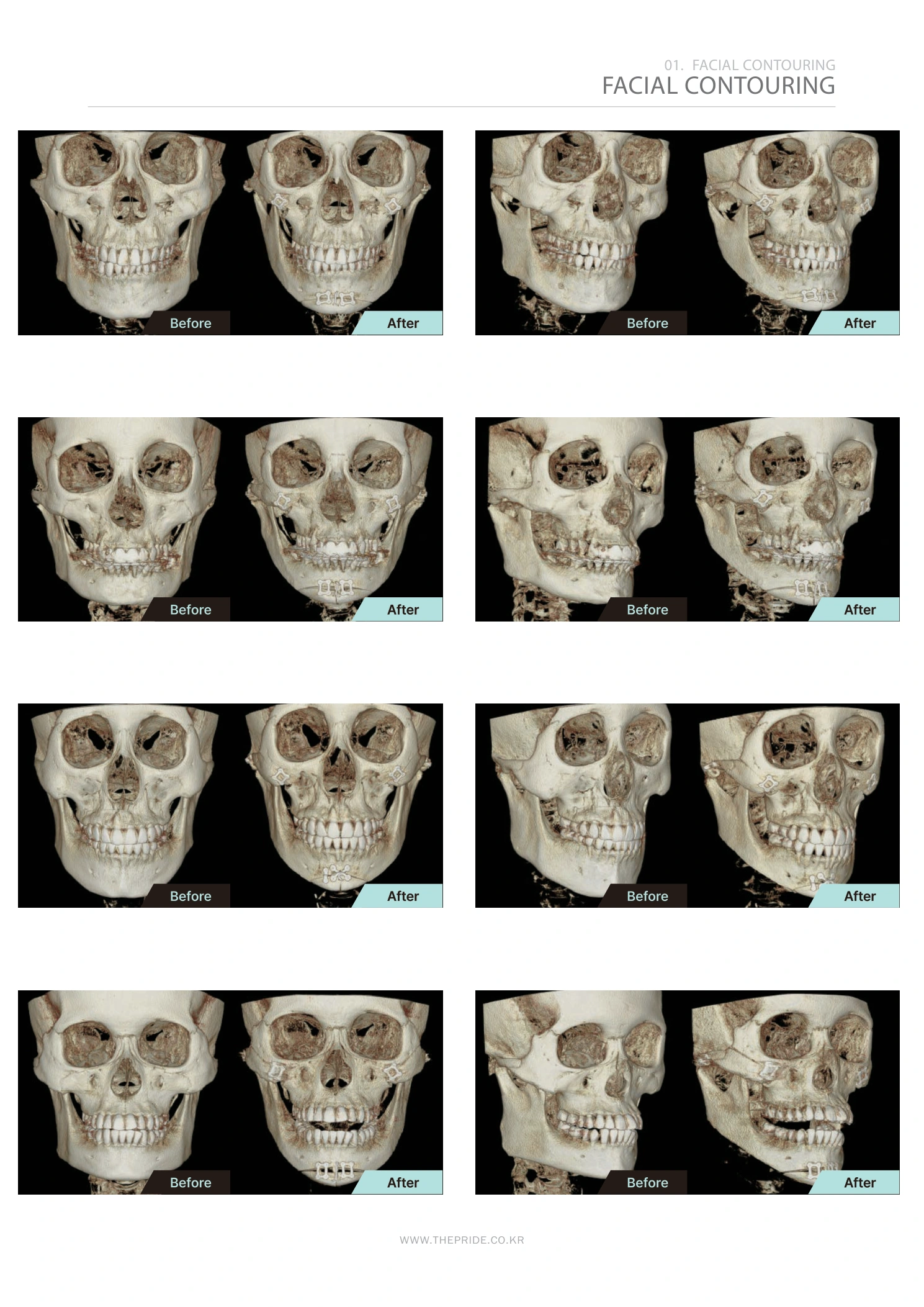 Facial contouring — scan comparisons at The Pride Plastic Surgery. The Pride Plastic Surgery, Seoul: facial contouring — scan comparisons, reproduced from page 29 of the clinic-supplied booklet. Before-and-after labels and photographed views remain as supplied.