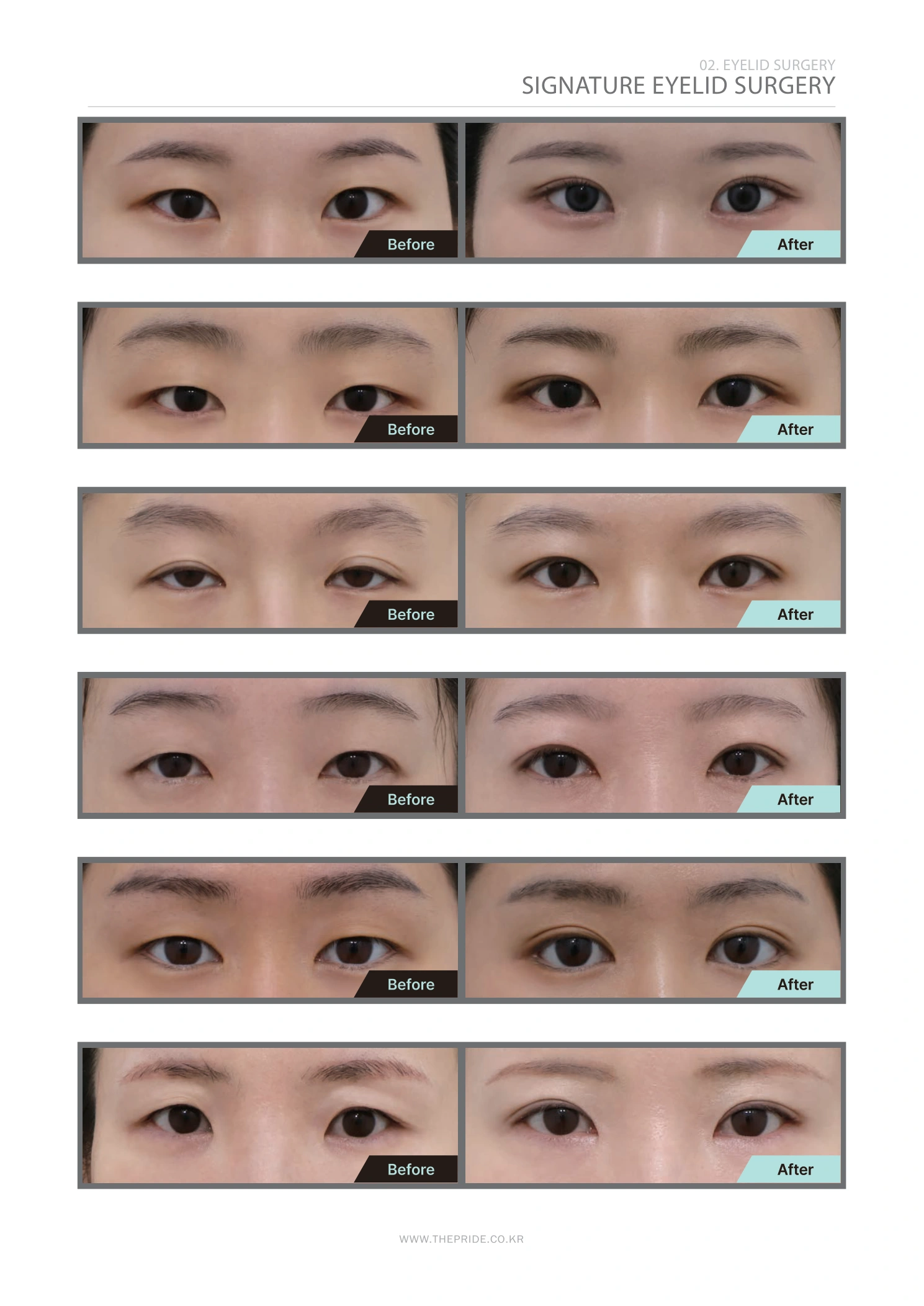 Eyelid surgery — comparison collection at The Pride Plastic Surgery. The Pride Plastic Surgery, Seoul: eyelid surgery — comparison collection, reproduced from page 31 of the clinic-supplied booklet. Before-and-after labels and photographed views remain as supplied.