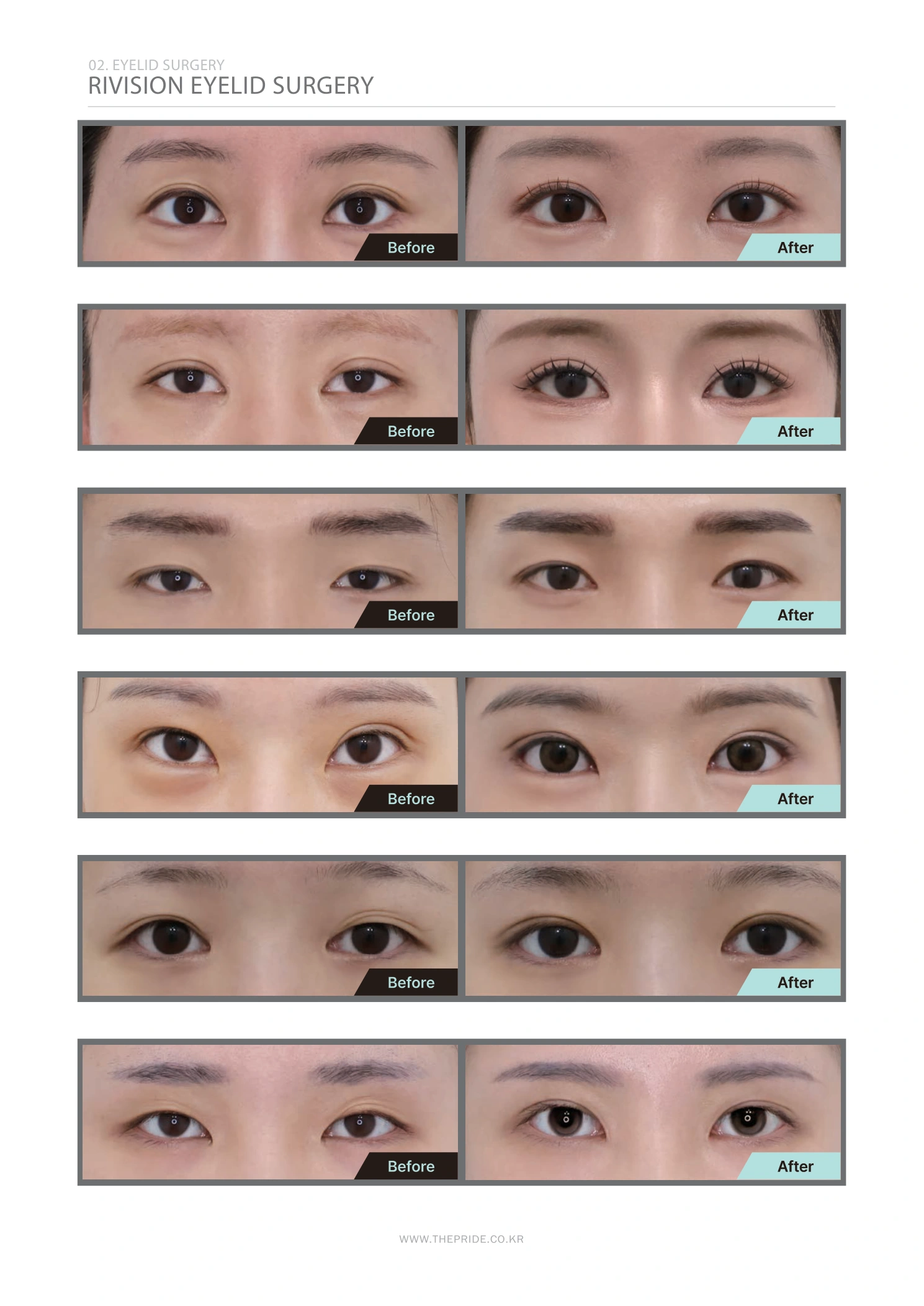 Revision eyelid surgery — comparison collection at The Pride Plastic Surgery. The Pride Plastic Surgery, Seoul: revision eyelid surgery — comparison collection, reproduced from page 32 of the clinic-supplied booklet. Before-and-after labels and photographed views remain as supplied.