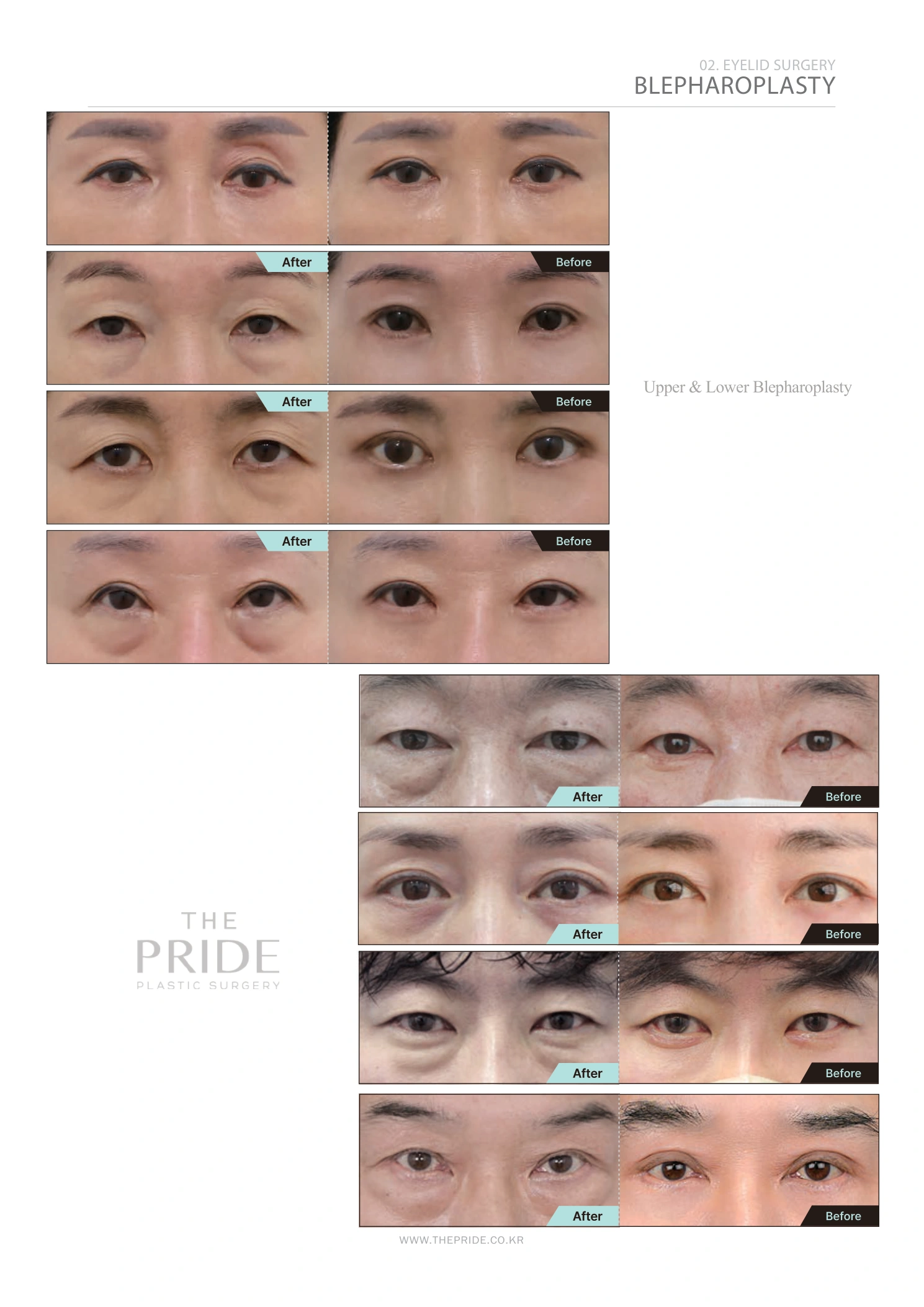 Upper and lower blepharoplasty — comparison collection at The Pride Plastic Surgery. The Pride Plastic Surgery, Seoul: upper and lower blepharoplasty — comparison collection, reproduced from page 33 of the clinic-supplied booklet. Before-and-after labels and photographed views remain as supplied.