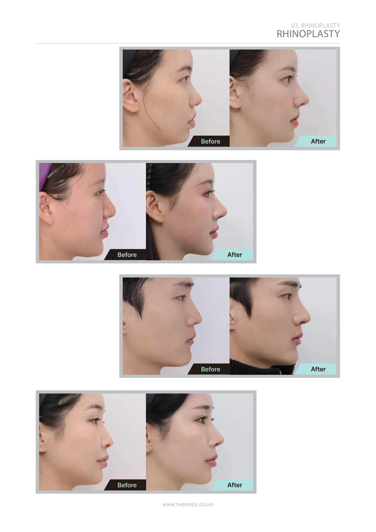Rhinoplasty — profile collection 01 at The Pride Plastic Surgery. The Pride Plastic Surgery, Seoul: rhinoplasty — profile collection 01, reproduced from page 35 of the clinic-supplied booklet. Before-and-after labels and photographed views remain as supplied.