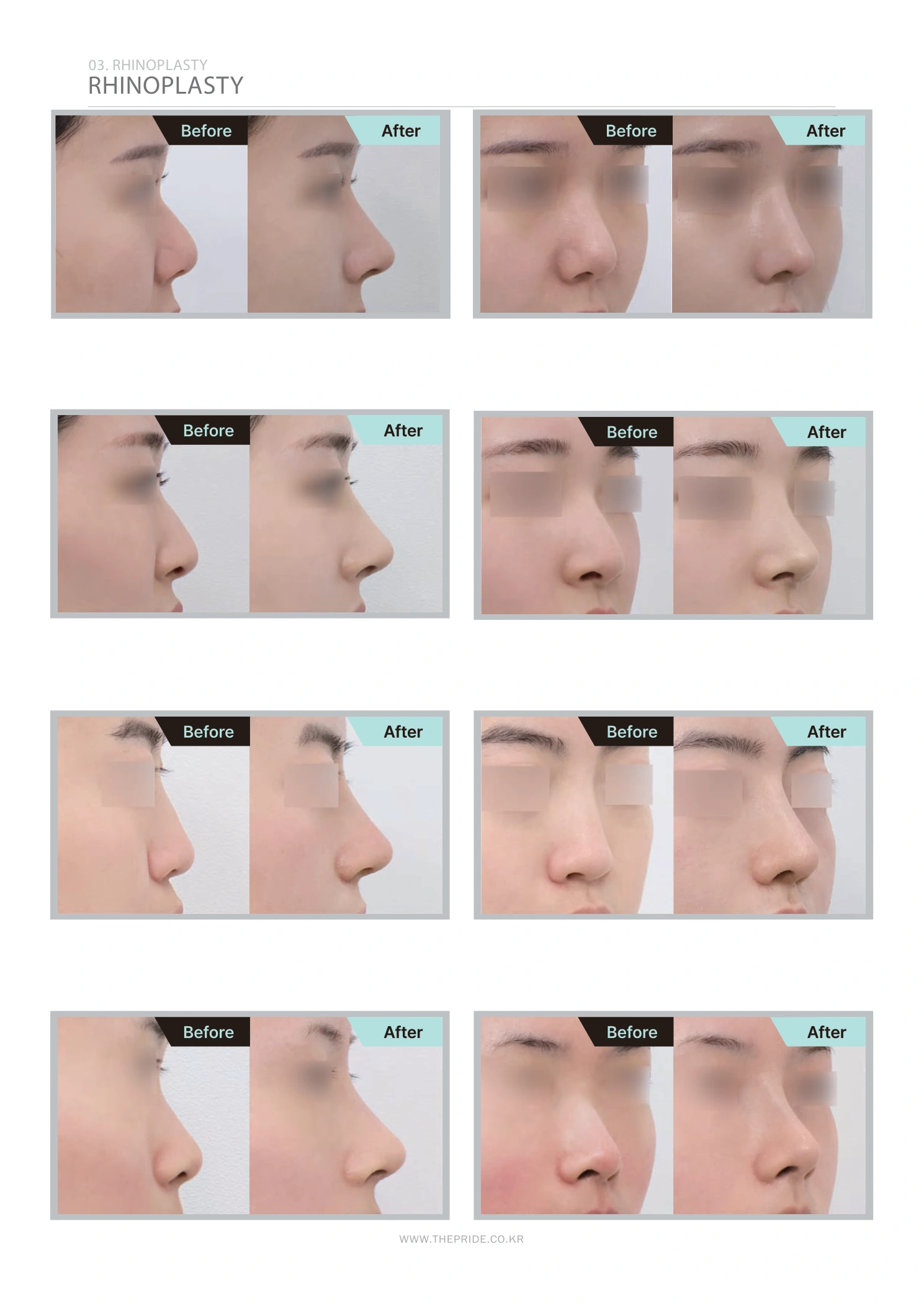 Rhinoplasty — angled collection at The Pride Plastic Surgery. The Pride Plastic Surgery, Seoul: rhinoplasty — angled collection, reproduced from page 36 of the clinic-supplied booklet. Before-and-after labels and photographed views remain as supplied.