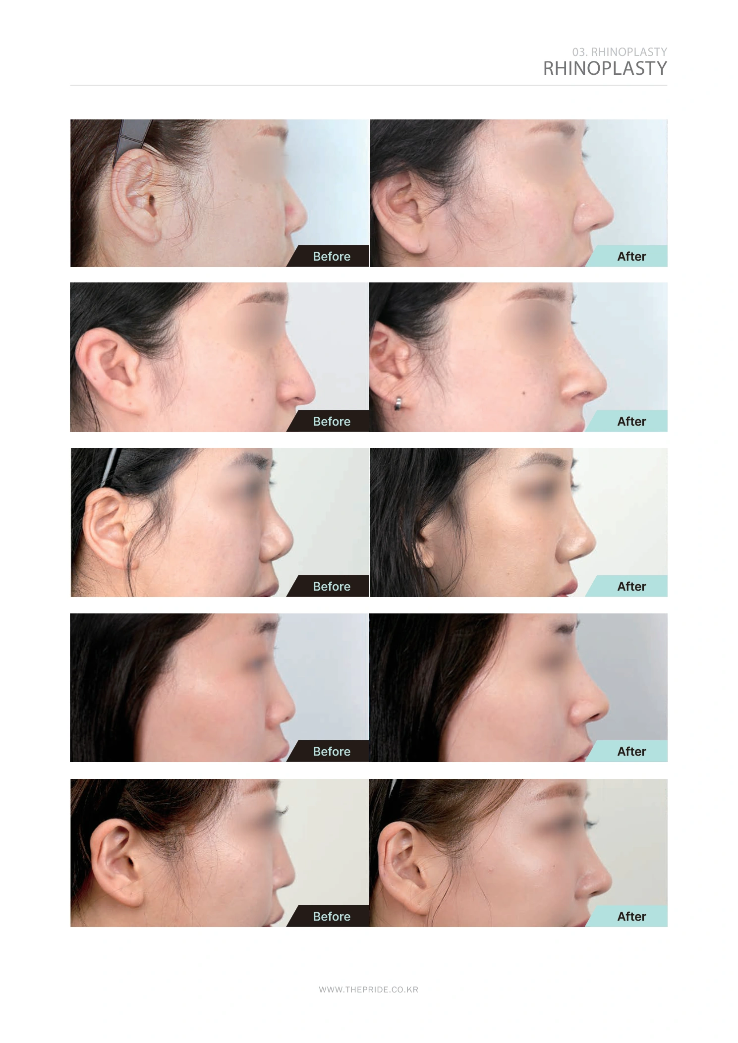 Rhinoplasty — profile collection 02 at The Pride Plastic Surgery. The Pride Plastic Surgery, Seoul: rhinoplasty — profile collection 02, reproduced from page 37 of the clinic-supplied booklet. Before-and-after labels and photographed views remain as supplied.