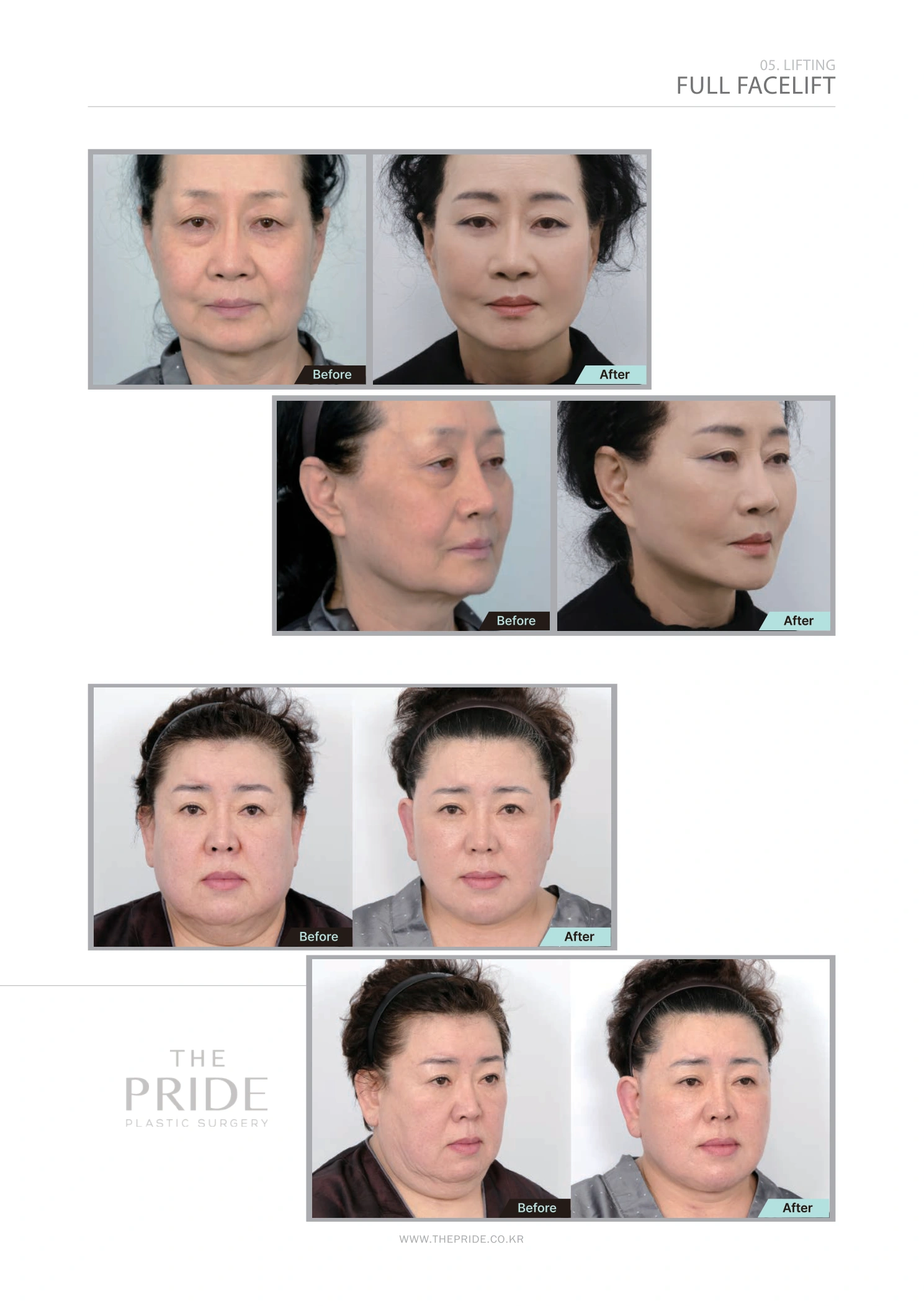 Full facelift — comparison collection at The Pride Plastic Surgery. The Pride Plastic Surgery, Seoul: full facelift — comparison collection, reproduced from page 39 of the clinic-supplied booklet. Before-and-after labels and photographed views remain as supplied.