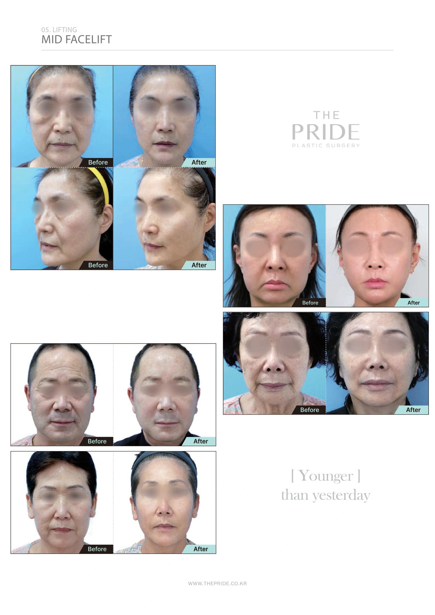 Midface lift — comparison collection at The Pride Plastic Surgery. The Pride Plastic Surgery, Seoul: midface lift — comparison collection, reproduced from page 40 of the clinic-supplied booklet. Before-and-after labels and photographed views remain as supplied.