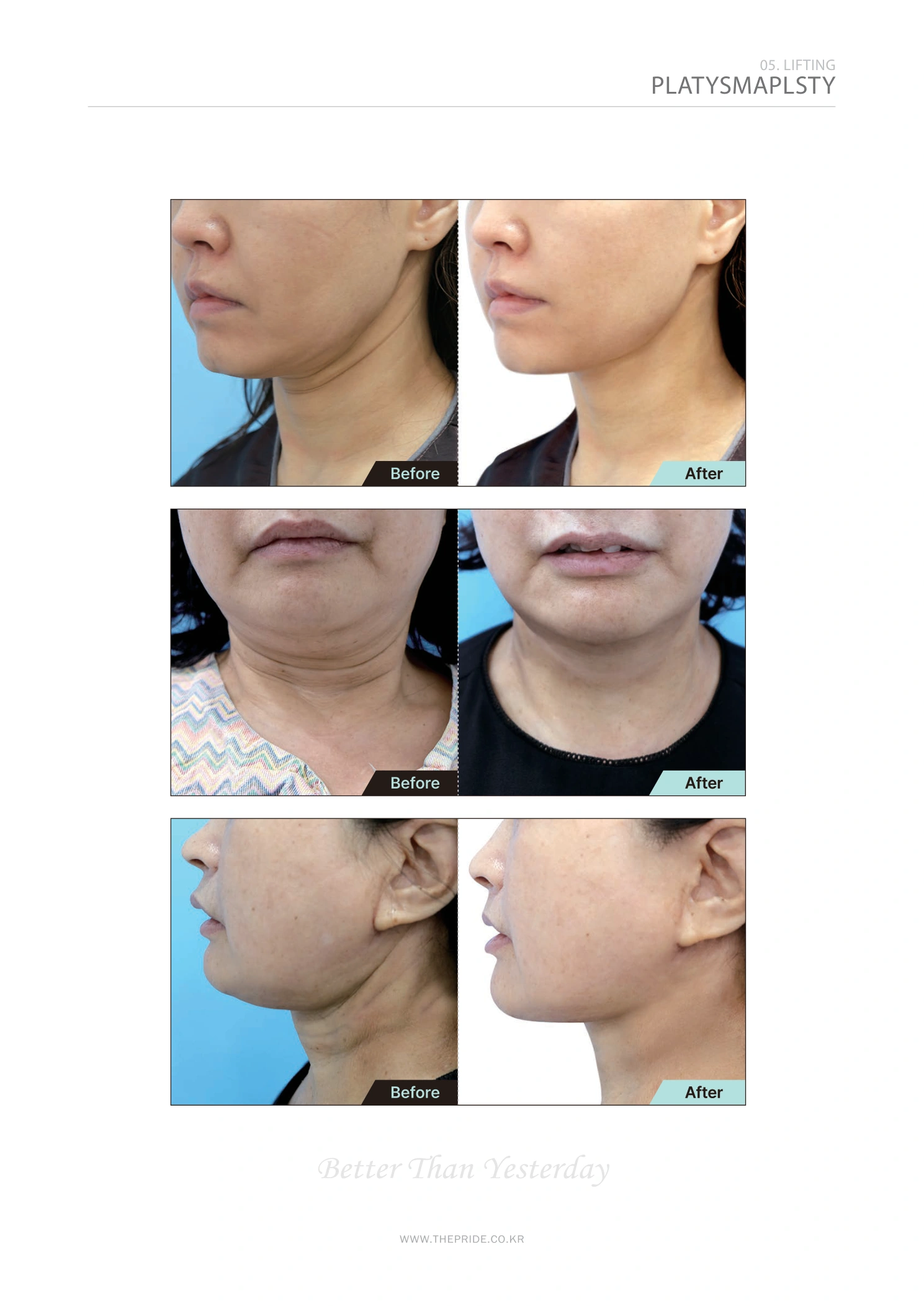 Platysmaplasty — neck contour comparisons at The Pride Plastic Surgery. The Pride Plastic Surgery, Seoul: platysmaplasty — neck contour comparisons, reproduced from page 41 of the clinic-supplied booklet. Before-and-after labels and photographed views remain as supplied.