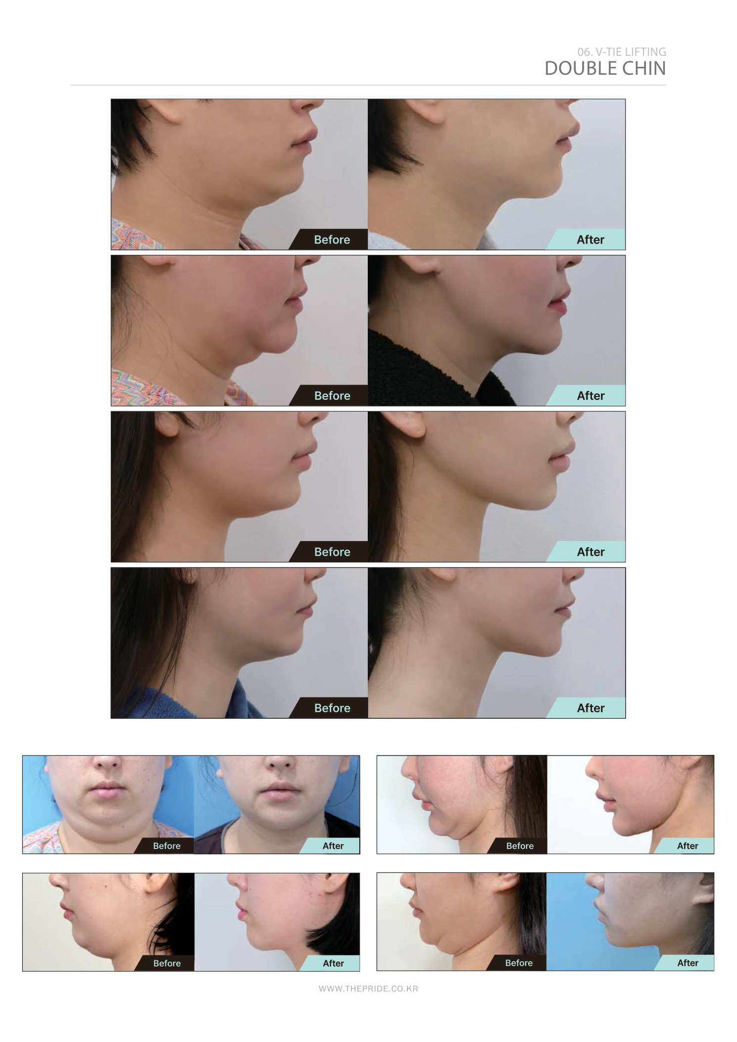 Double-chin treatment — V-Tie lifting collection at The Pride Plastic Surgery. The Pride Plastic Surgery, Seoul: double-chin treatment — v-tie lifting collection, reproduced from page 43 of the clinic-supplied booklet. Before-and-after labels and photographed views remain as supplied.