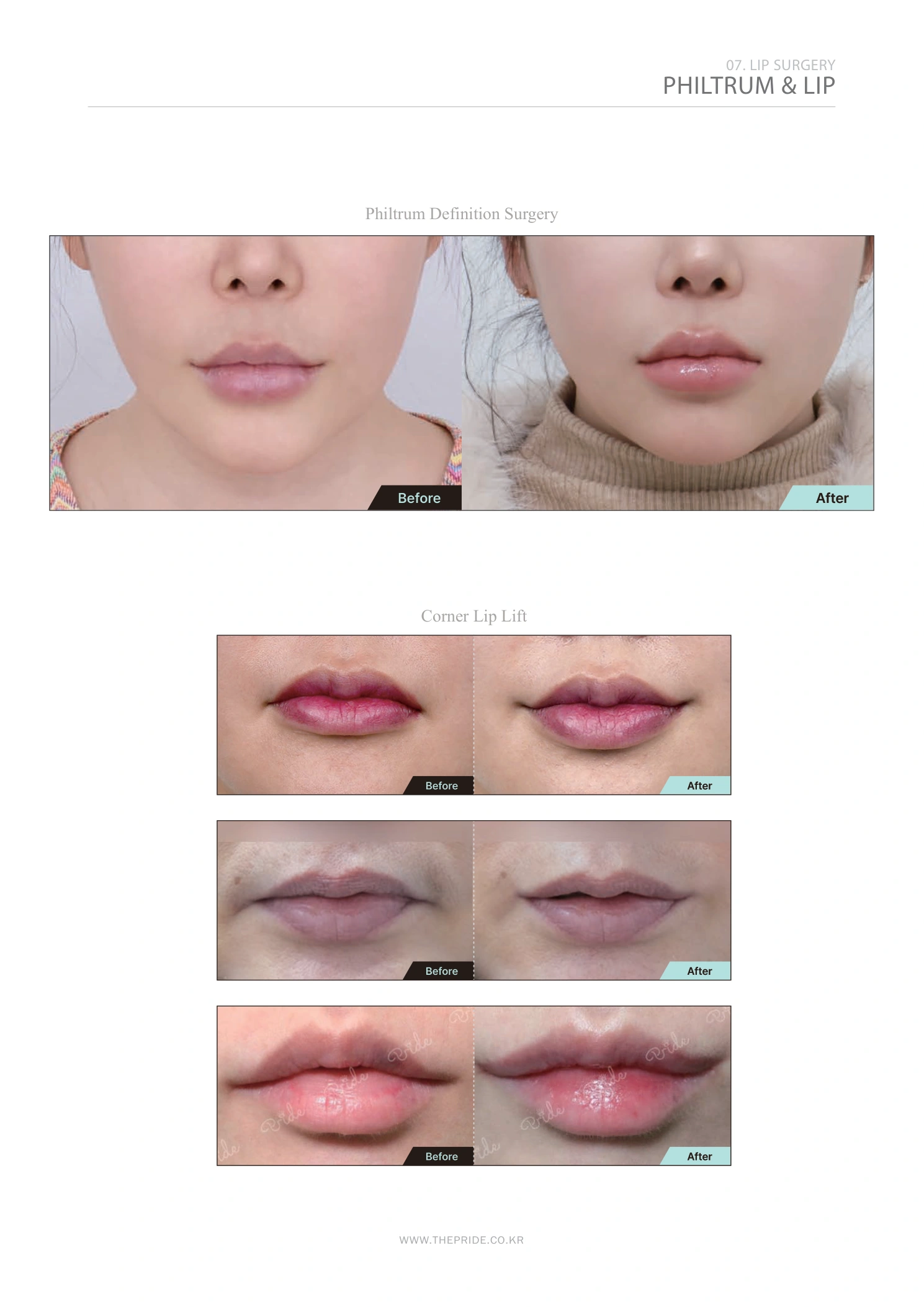 Philtrum and lip surgery — comparison collection at The Pride Plastic Surgery. The Pride Plastic Surgery, Seoul: philtrum and lip surgery — comparison collection, reproduced from page 45 of the clinic-supplied booklet. Before-and-after labels and photographed views remain as supplied.
