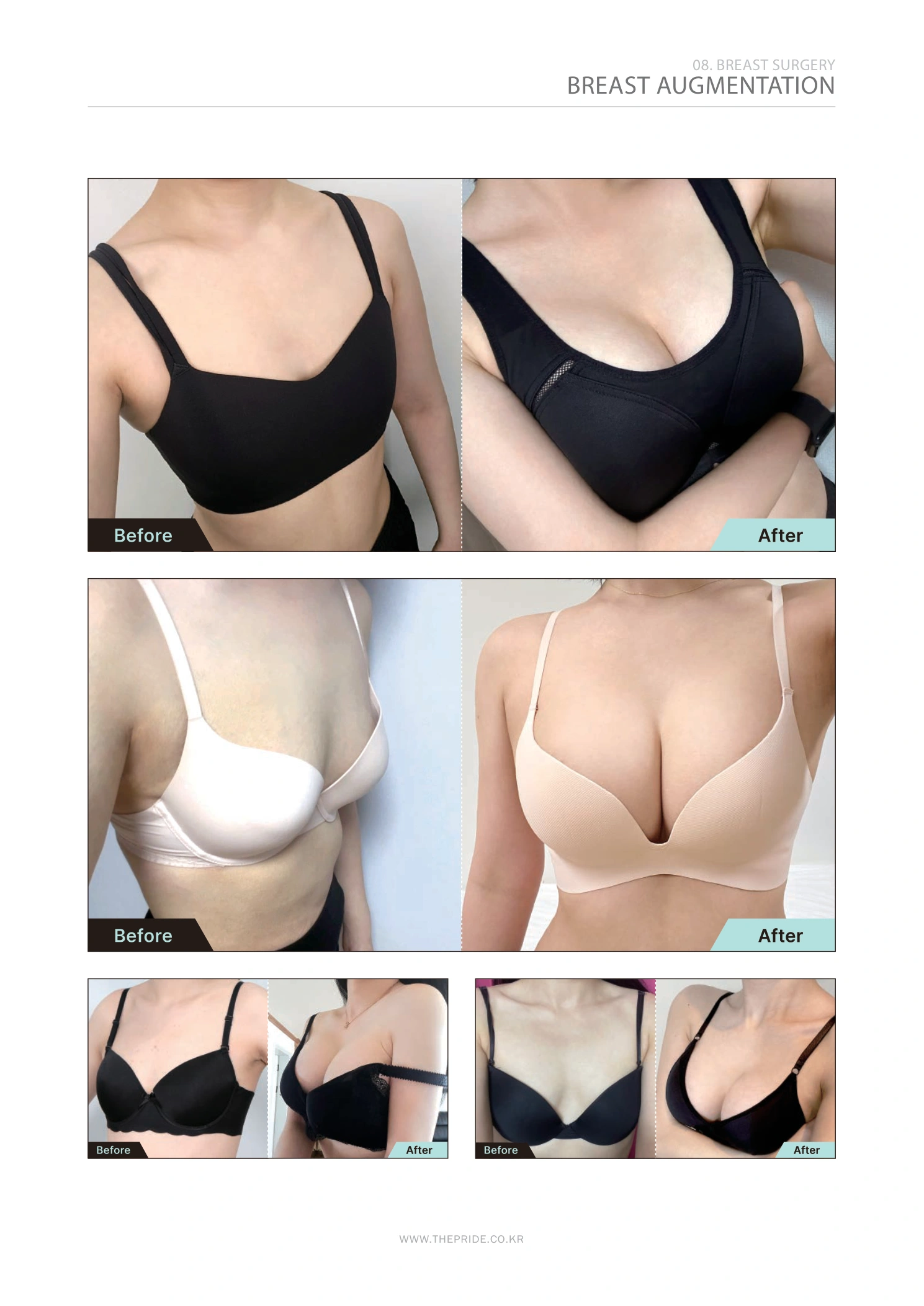 Breast augmentation — collection 01 at The Pride Plastic Surgery. The Pride Plastic Surgery, Seoul: breast augmentation — collection 01, reproduced from page 47 of the clinic-supplied booklet. Before-and-after labels and photographed views remain as supplied.