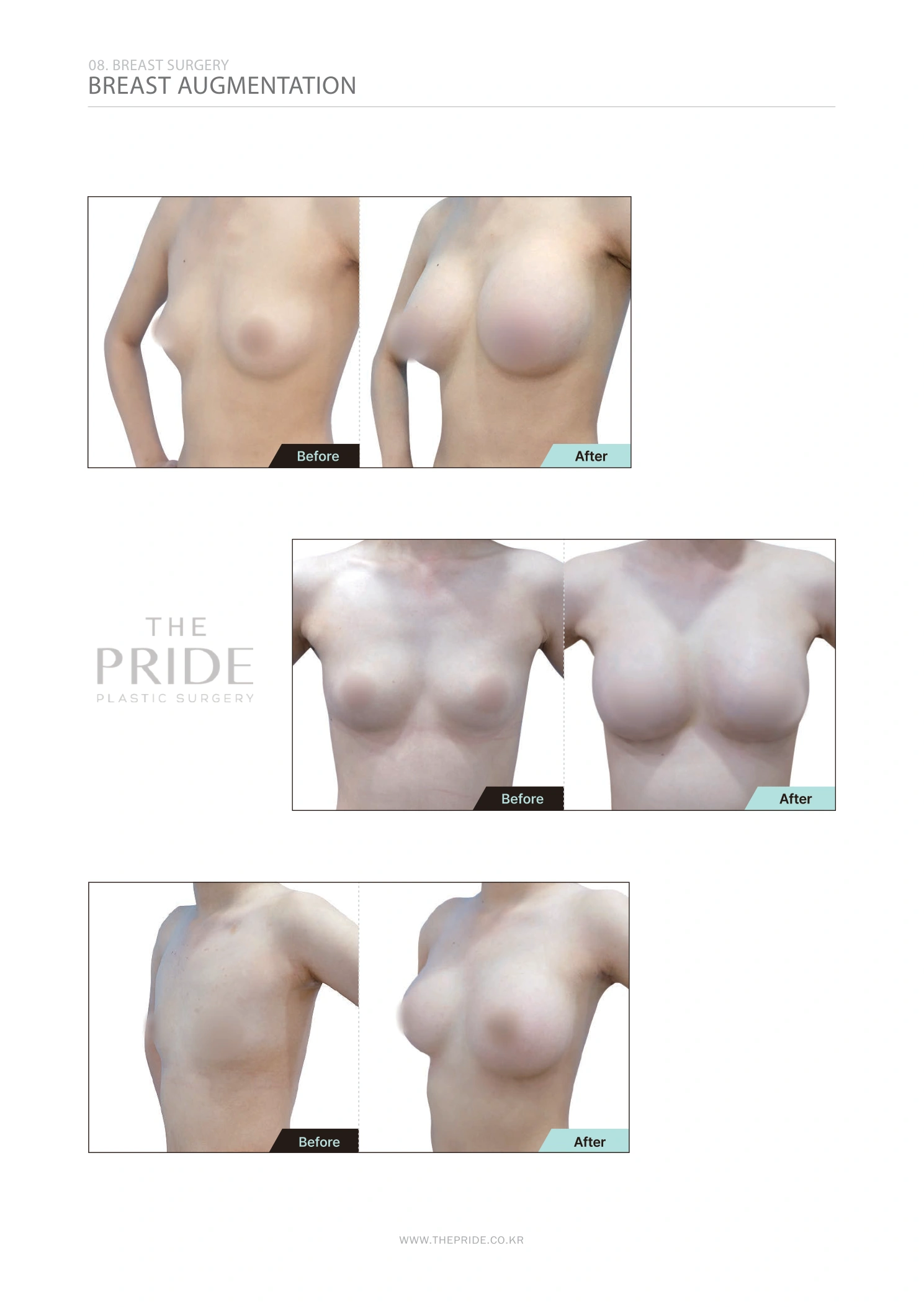 Breast augmentation — collection 02 at The Pride Plastic Surgery. The Pride Plastic Surgery, Seoul: breast augmentation — collection 02, reproduced from page 48 of the clinic-supplied booklet. Before-and-after labels and photographed views remain as supplied.