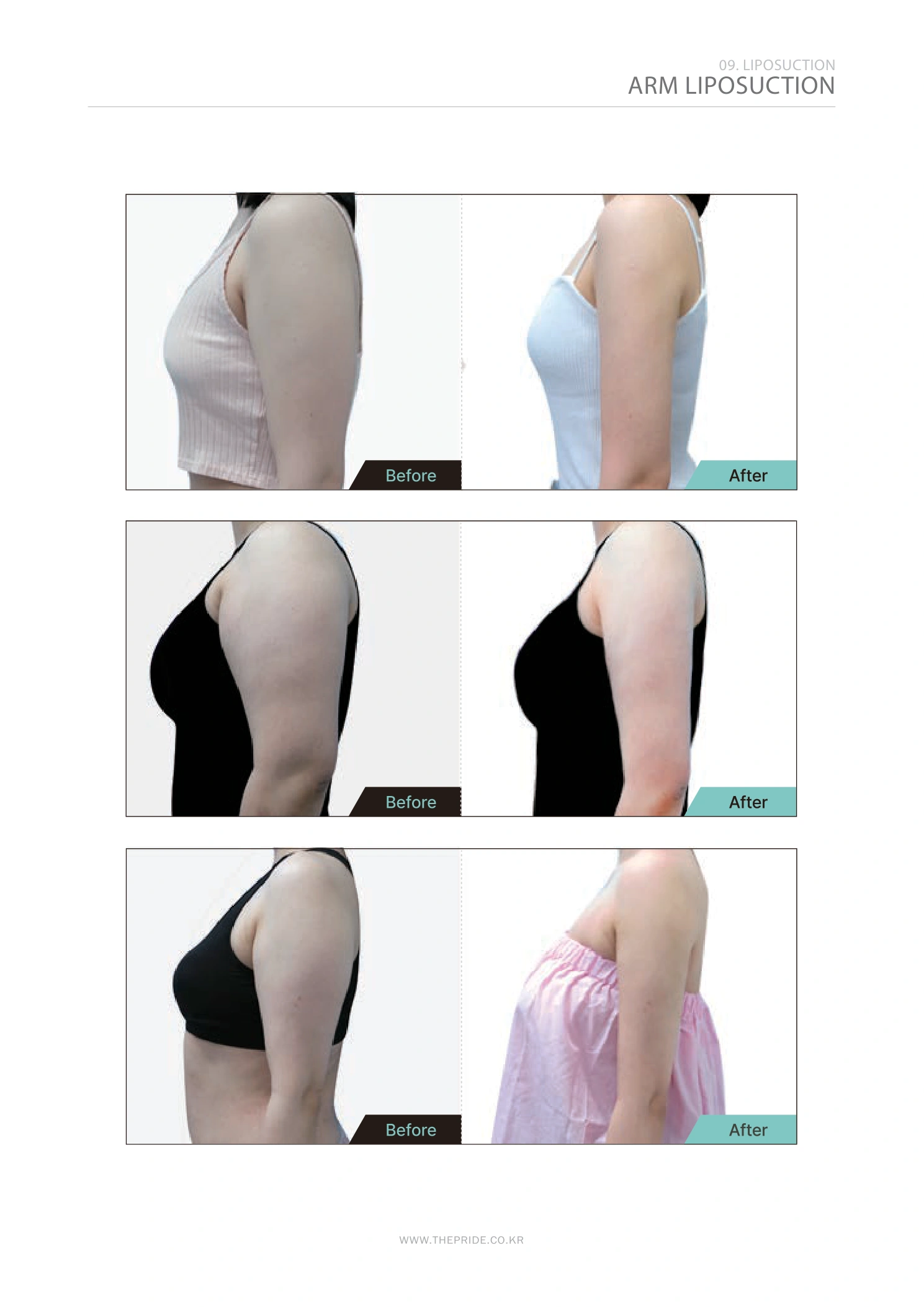 Arm liposuction — comparison collection at The Pride Plastic Surgery. The Pride Plastic Surgery, Seoul: arm liposuction — comparison collection, reproduced from page 51 of the clinic-supplied booklet. Before-and-after labels and photographed views remain as supplied.