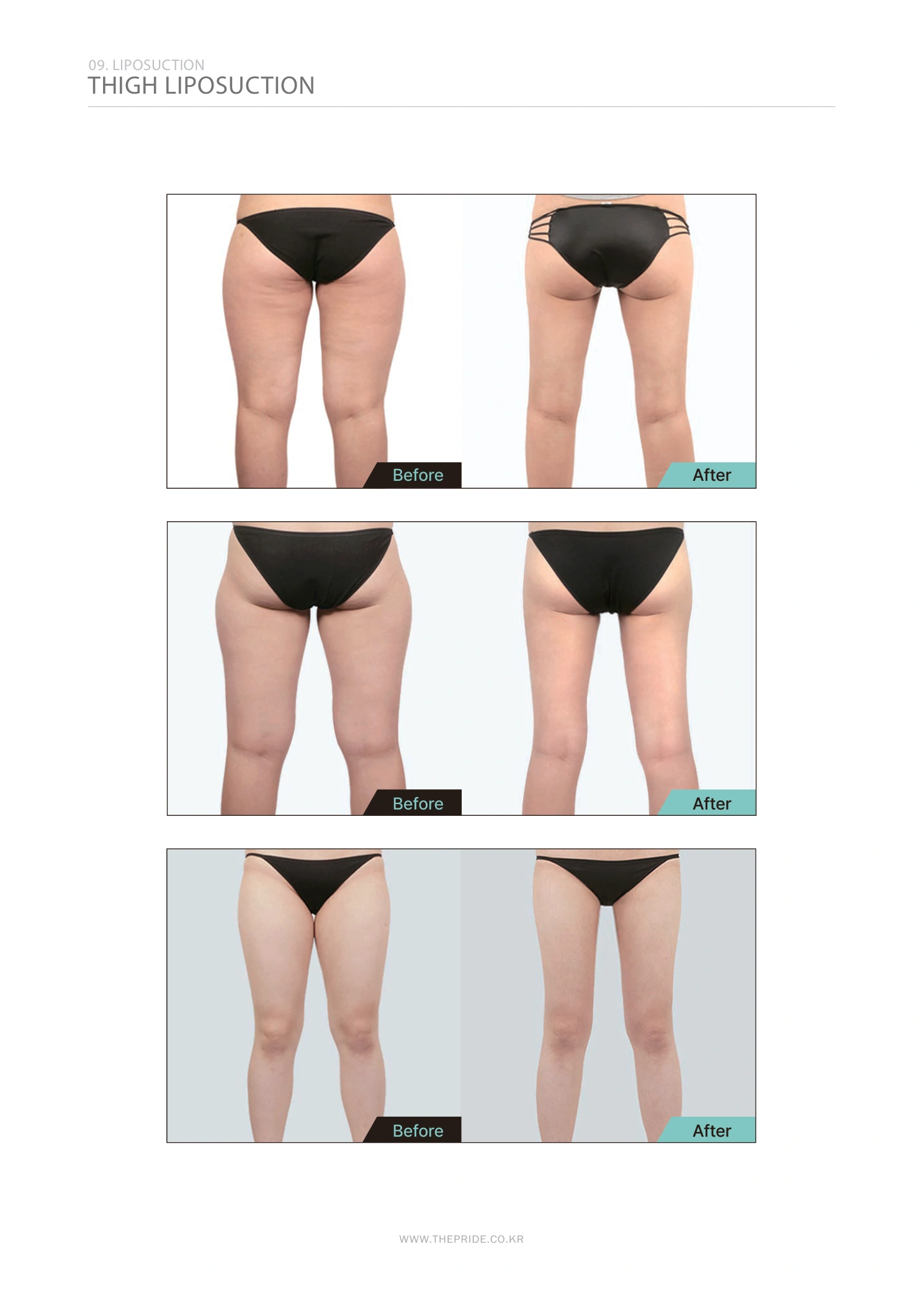Thigh liposuction — comparison collection at The Pride Plastic Surgery. The Pride Plastic Surgery, Seoul: thigh liposuction — comparison collection, reproduced from page 52 of the clinic-supplied booklet. Before-and-after labels and photographed views remain as supplied.