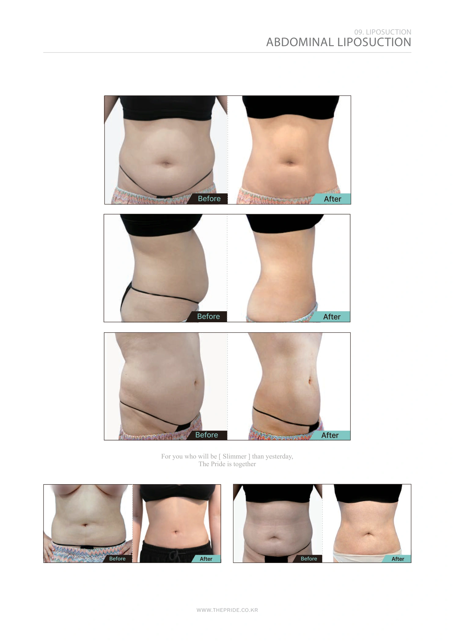 Abdominal liposuction — comparison collection at The Pride Plastic Surgery. The Pride Plastic Surgery, Seoul: abdominal liposuction — comparison collection, reproduced from page 53 of the clinic-supplied booklet. Before-and-after labels and photographed views remain as supplied.