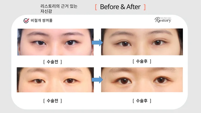 Non-incisional double-eyelid surgery: two comparisons · 002 at Restory Plastic Surgery Clinic. Front view. Two separate comparisons, each with before on the left and after on the right. The photographs show the eyelid contours, brows and their relationship to the upper cheeks. The follow-up interval is not stated.