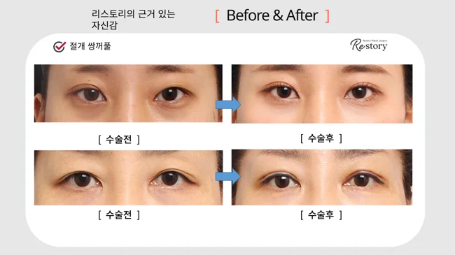 Incisional double-eyelid surgery: two comparisons · 003 at Restory Plastic Surgery Clinic. Front view. Two separate comparisons, each with before on the left and after on the right. The photographs show the eyelid contours, brows and their relationship to the upper cheeks. The follow-up interval is not stated.