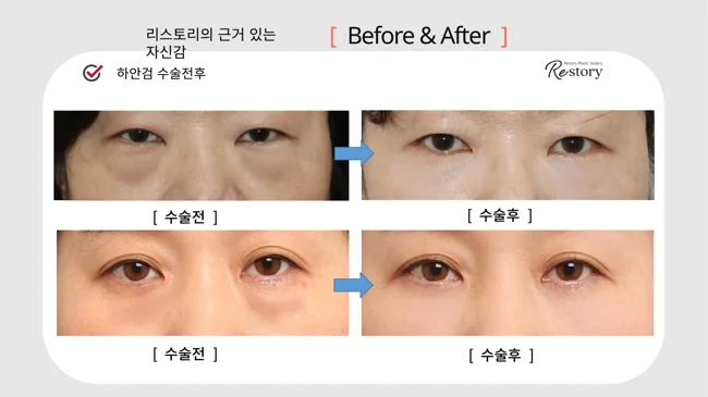 Lower blepharoplasty: two comparisons · 004 at Restory Plastic Surgery Clinic. Front view. Two separate comparisons, each with before on the left and after on the right. The photographs show the eyelid contours, brows and their relationship to the upper cheeks. The follow-up interval is not stated.