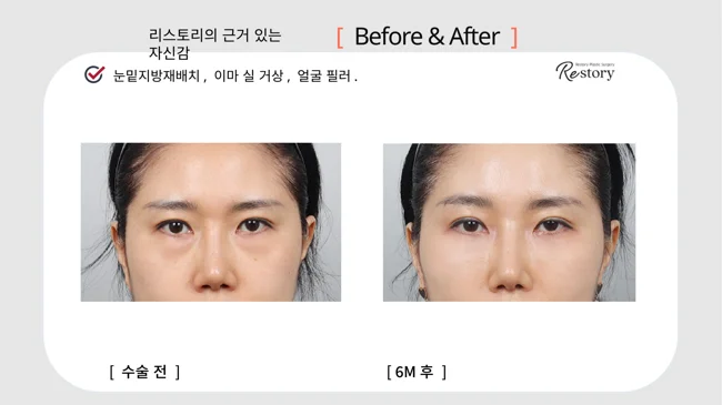 Under-eye fat repositioning, forehead thread lift and fillers · 005 at Restory Plastic Surgery Clinic. Front view. Before on the left; after on the right. The photographs show the eyelid contours, brows and their relationship to the upper cheeks. The after photograph is labelled 6 months.